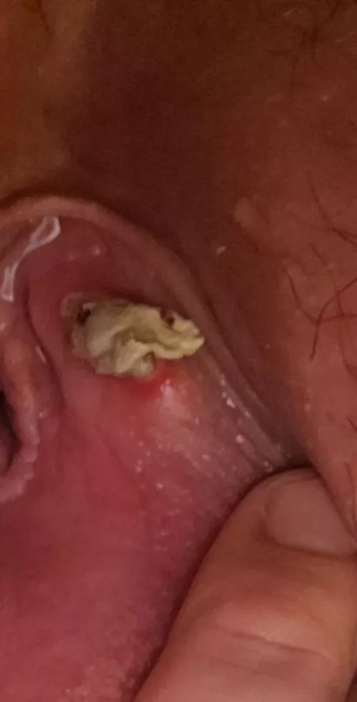 Bartholin's Cyst Wall Coming Out by fuckyeahshugah