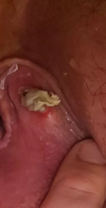 Bartholin's Cyst Wall Coming Out posted by fuckyeahshugah