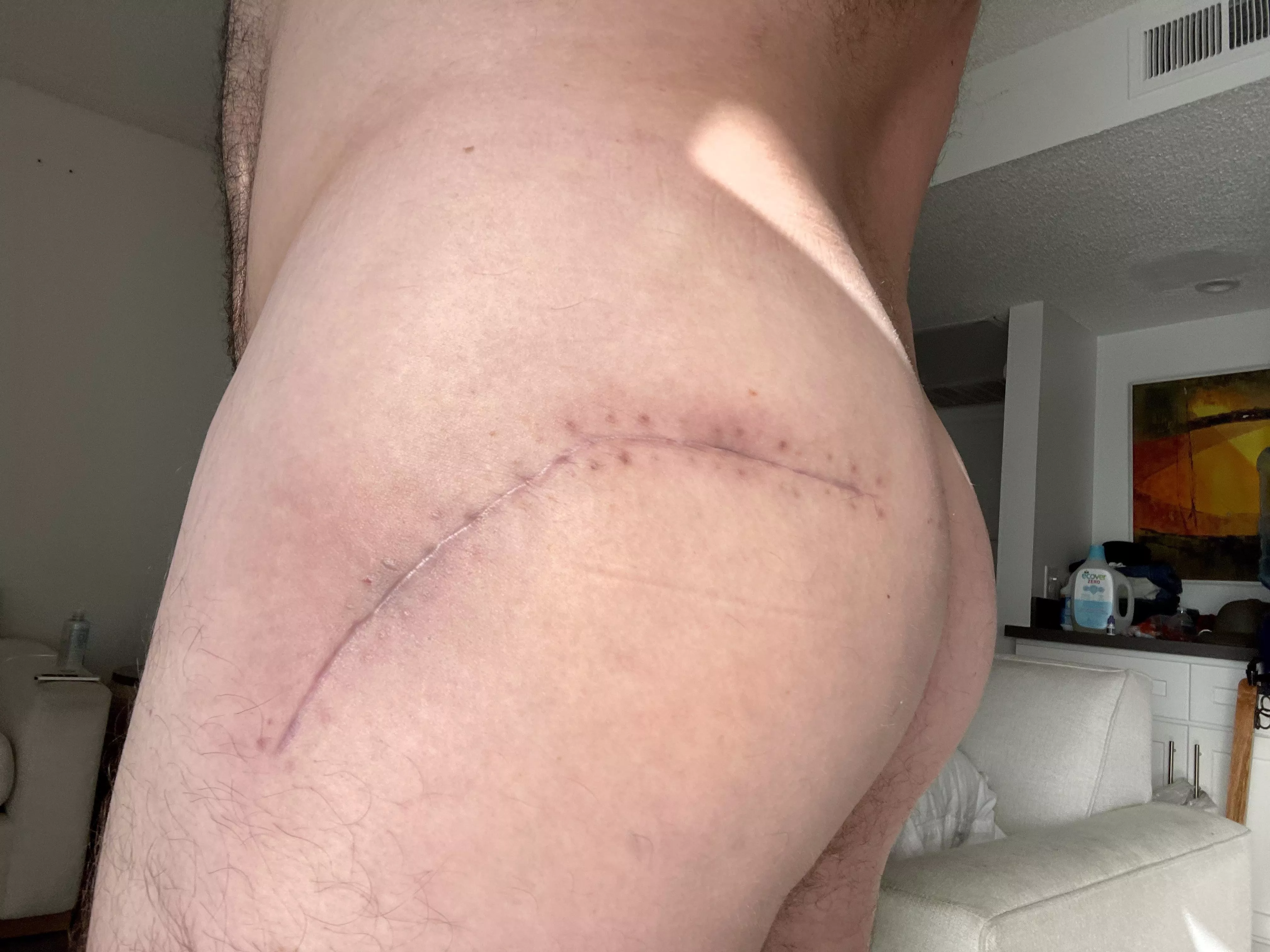 Like my scar? posted by eatpalmsprings