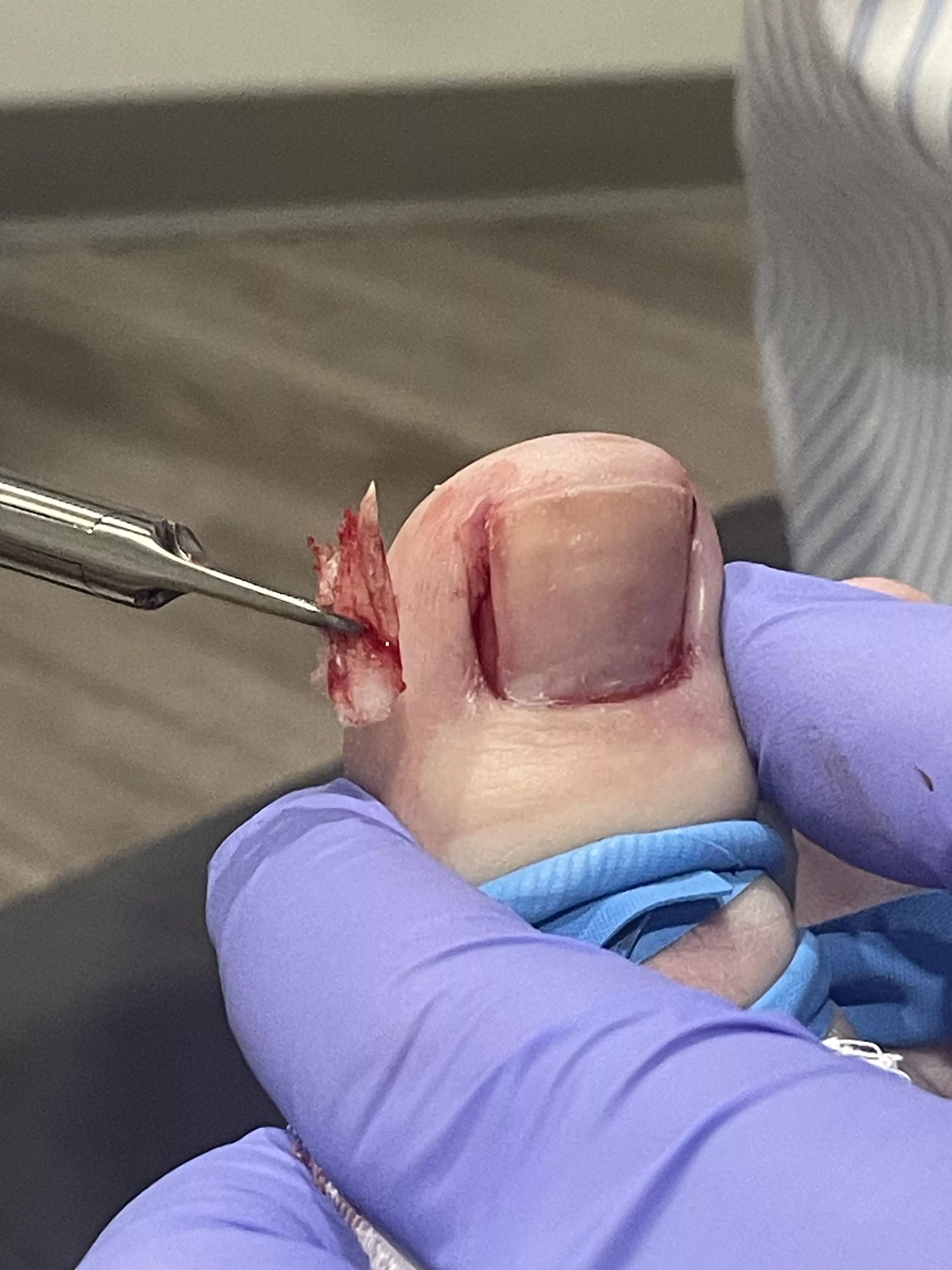 My satisfying ingrown toenail removal posted by 6664206958008