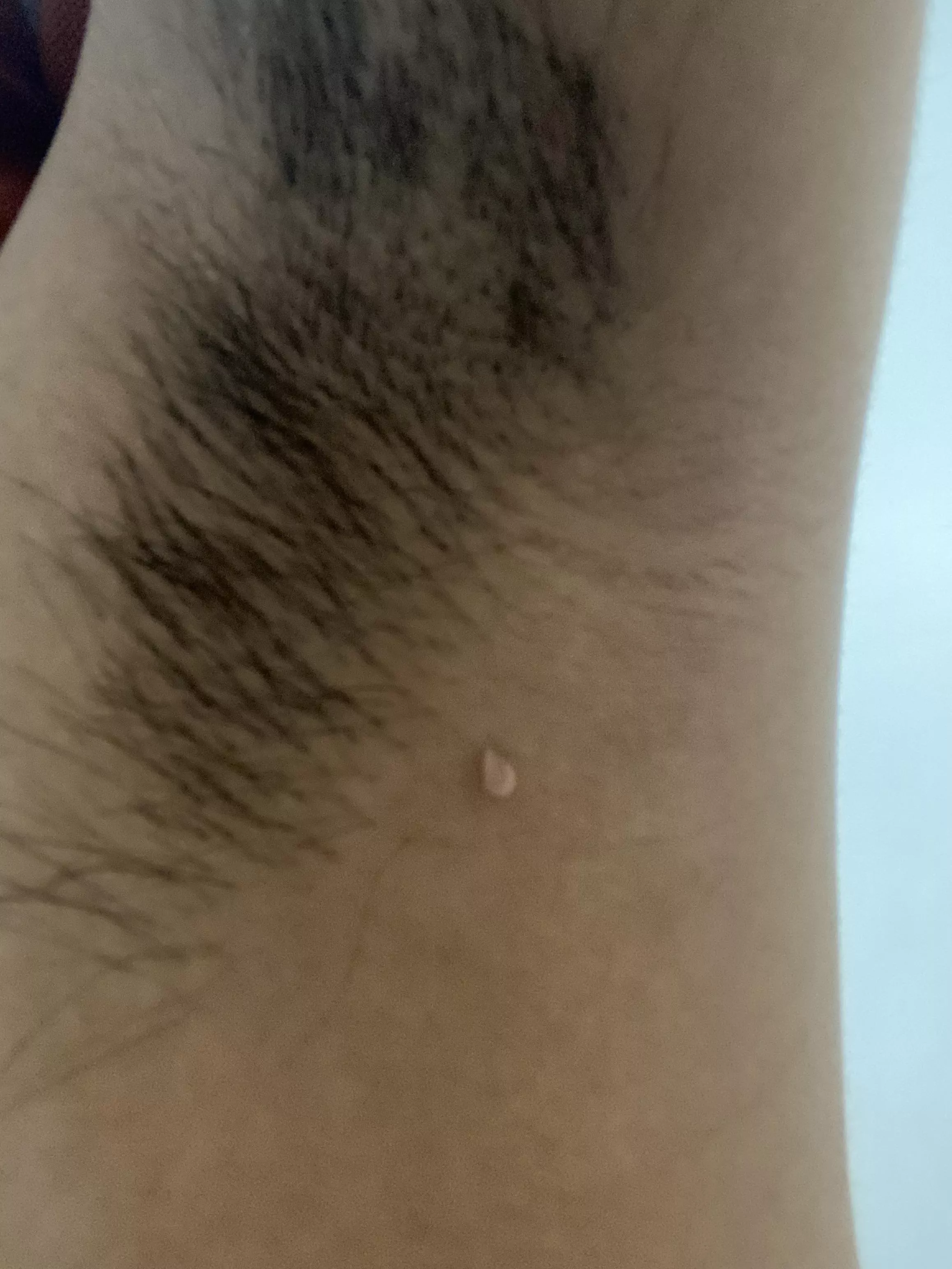 “Loose pimple” like thing under armpit posted by Diligent_Read567