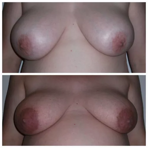 Friend pre-pregnancy to end of pregnancy. They definitely got engorged and veiny. Hope you enjoy. by hnyauscpl81