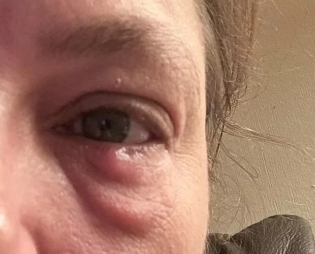 The forbidden pop - Eye stye by mollygirlcyr