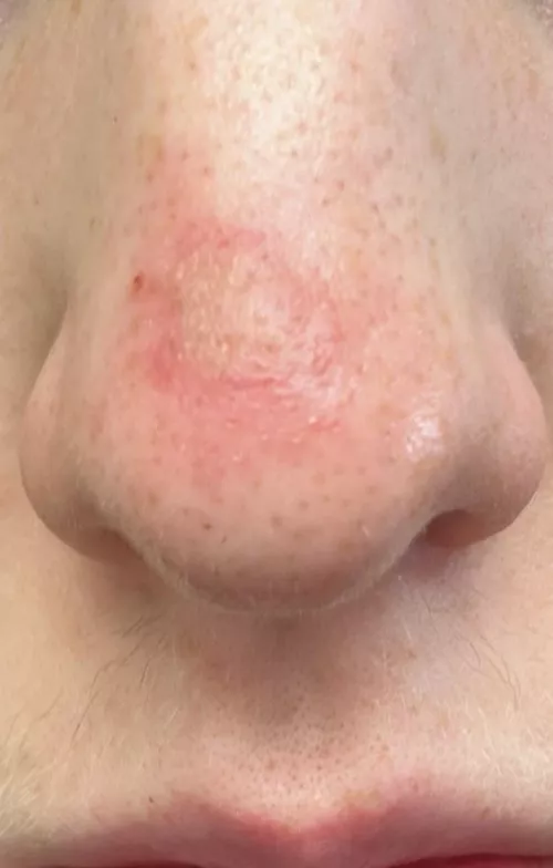 Is this infected? I popped a big blackhead on my nose yesterday and it turned into this by yavred
