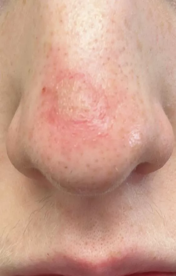 Is this infected? I popped a big blackhead on my nose yesterday and it turned into this posted by yavred