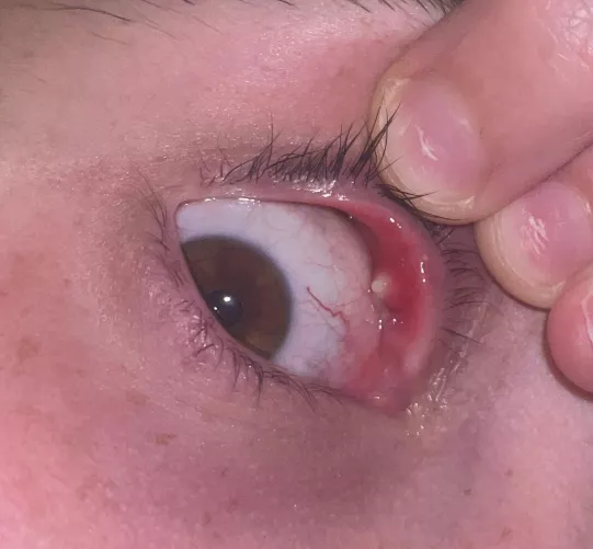 Largest Internal Stye I’ve Ever Had by lilivygreen20