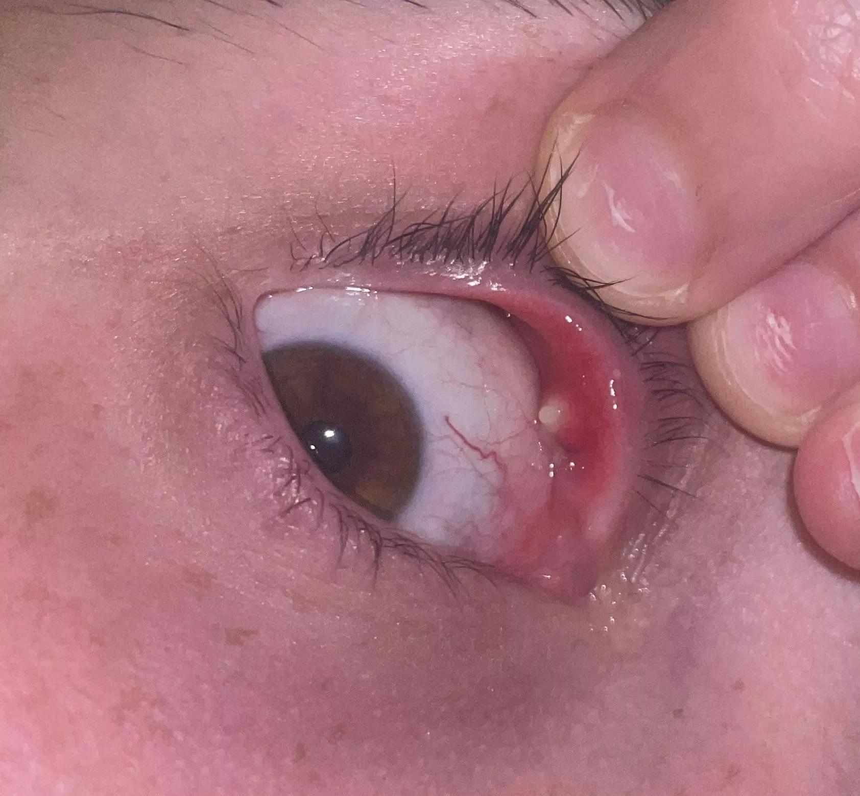 Largest Internal Stye I’ve Ever Had posted by lilivygreen20