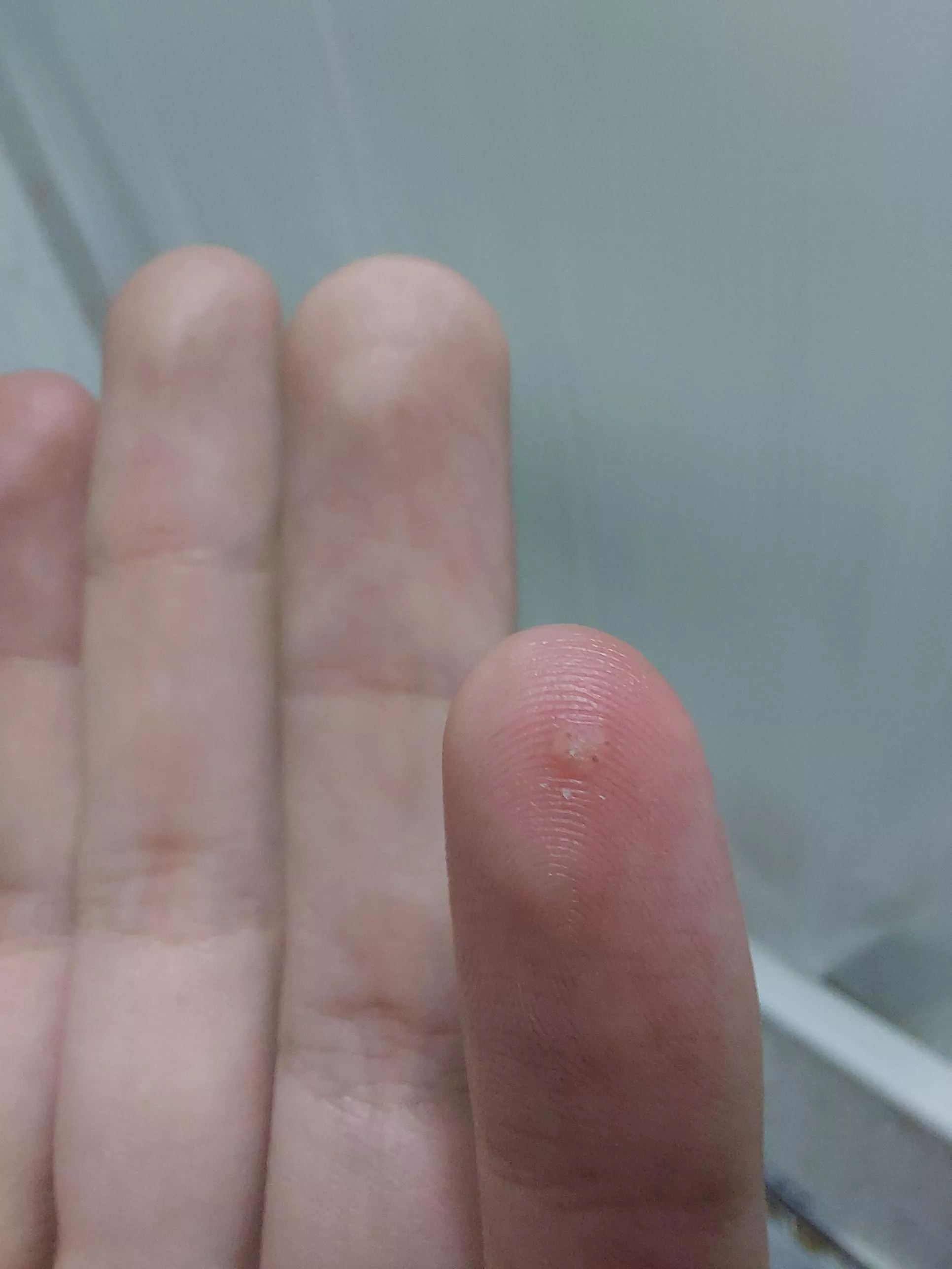 This weird bubble appeared on my finger suddenly, is it a bug growing inside me like a fly, and should I pop it? posted by JOTA-137_0