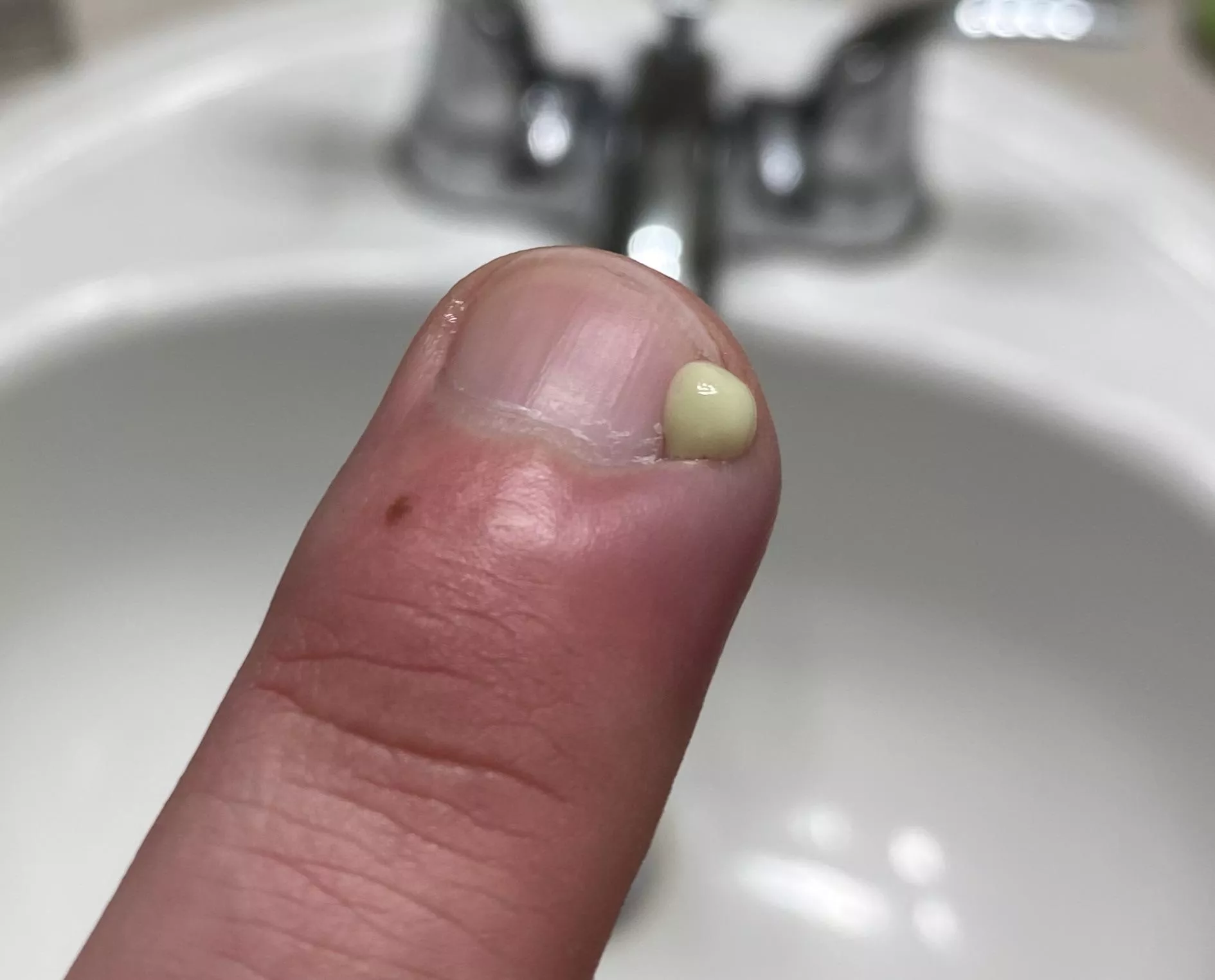 Was hoping this fucker went away on its own, but had to take matters into my own hands (literally) posted by VFL416