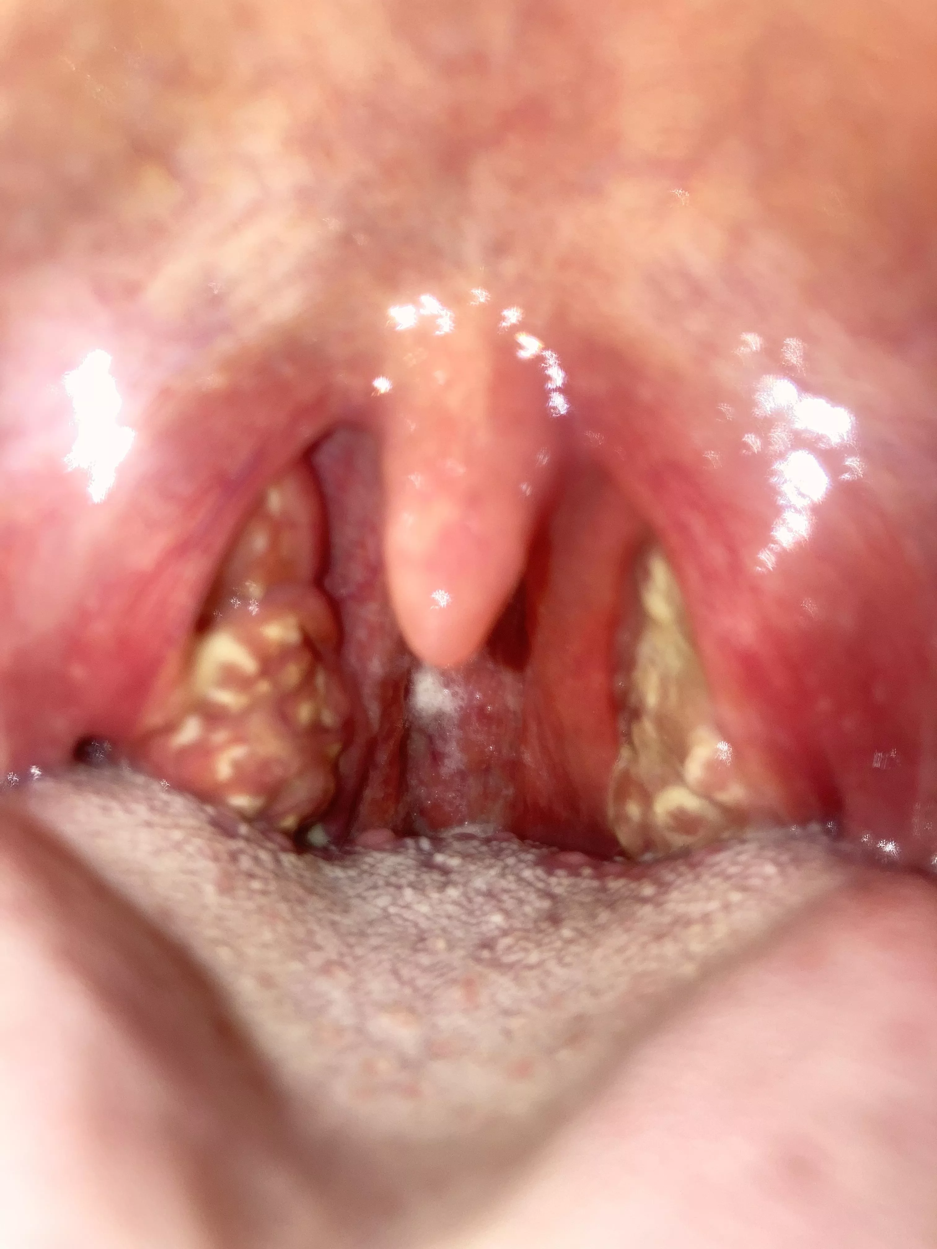 Absolutely gnarly strep throat. Never had it before and hurt so bad I had to go to the emergency room and get Percocet. I’m barely able to swallow and foods or liquids. It’s a 10/10 pain when I have to swallow. Currently spitting in a bottle. posted by EvAnH311