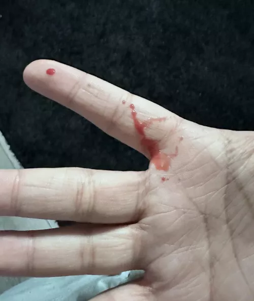 Aftermath of a pimple/boil by boldandzesty