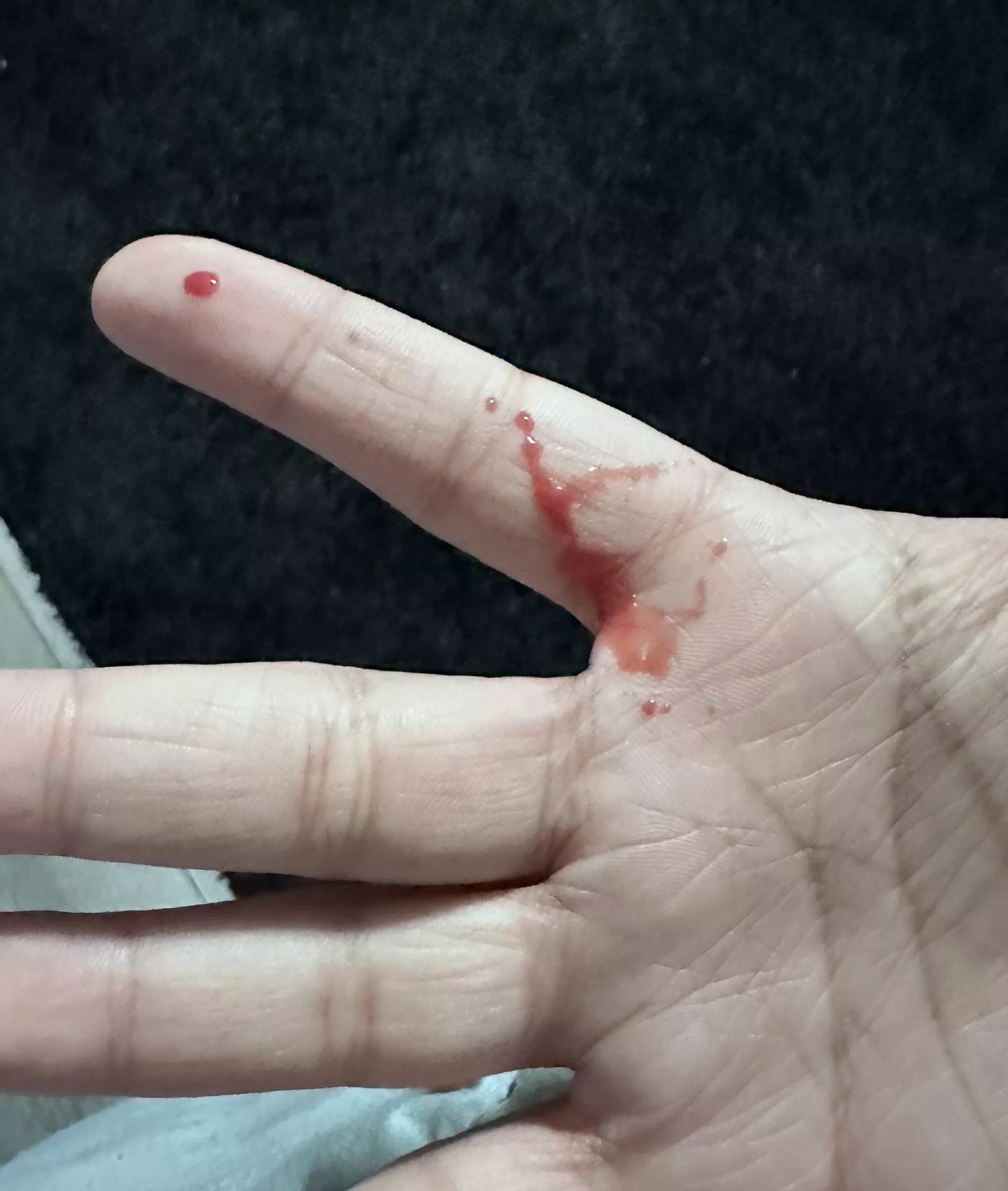 Aftermath of a pimple/boil posted by boldandzesty