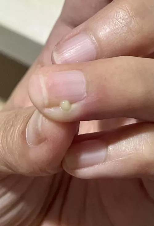 Used a (sterilised) needle to pop and it felt nice by misty_throwaway