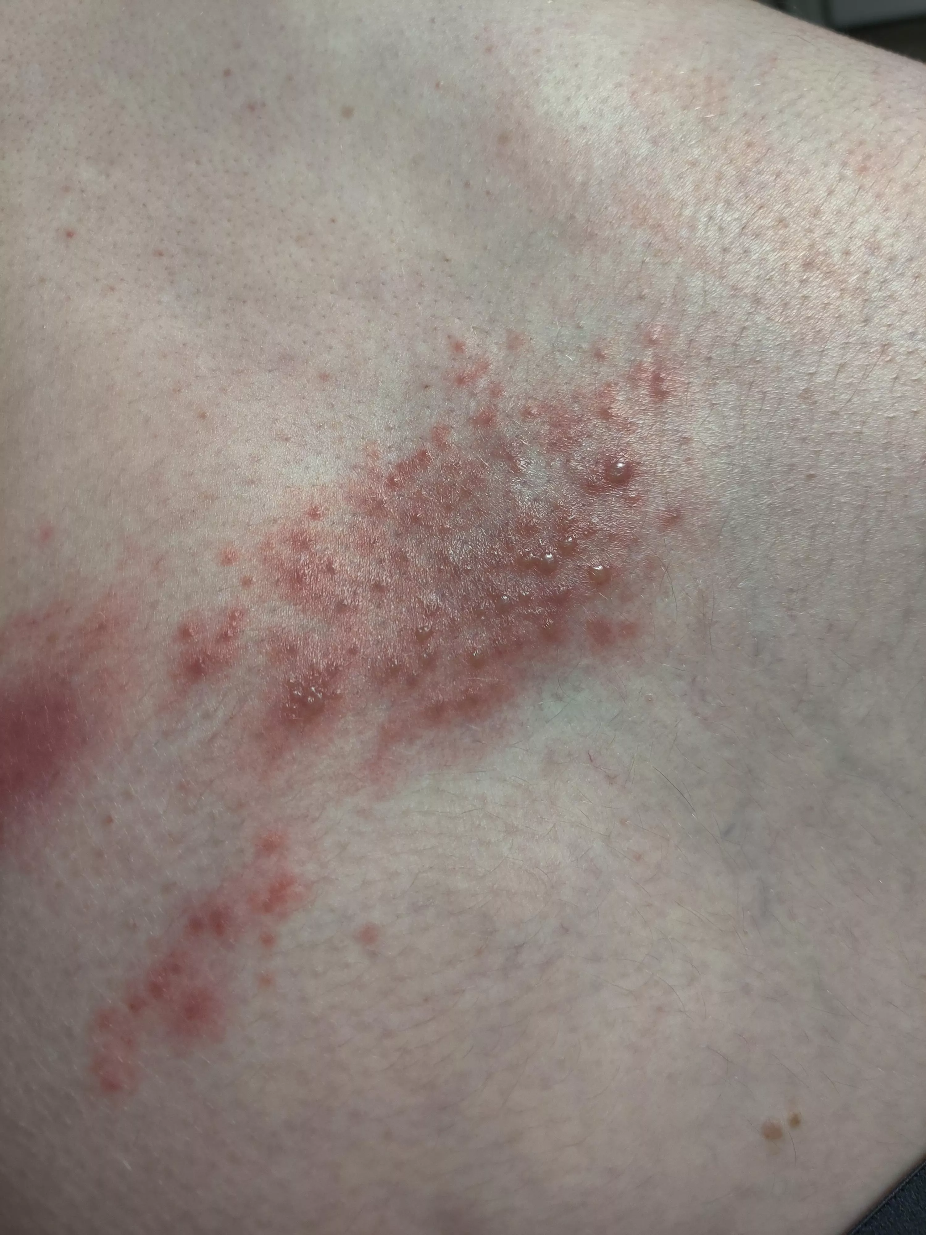 Forbidden pops - hubs got shingles posted by julesbot3k