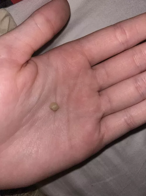 got the biggest tonsil stone i’ve ever gotten by bisexualwhore