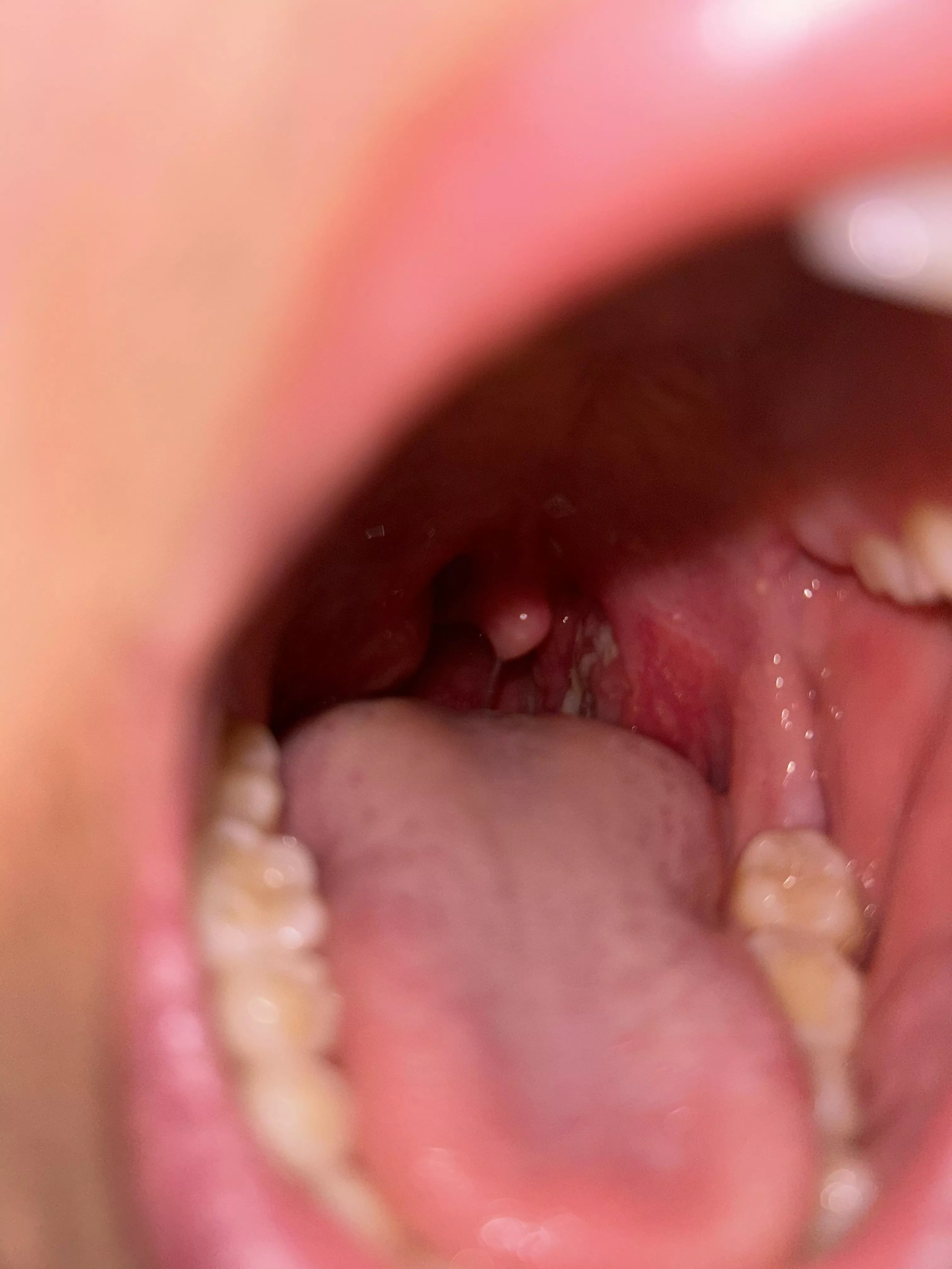 Is it tonsillitis or an abscess? posted by nuumyte