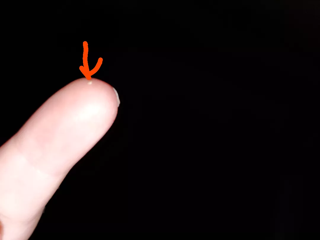 Really gross keratin plug I popped out of my forehead posted by TheQueen_Of-Vore