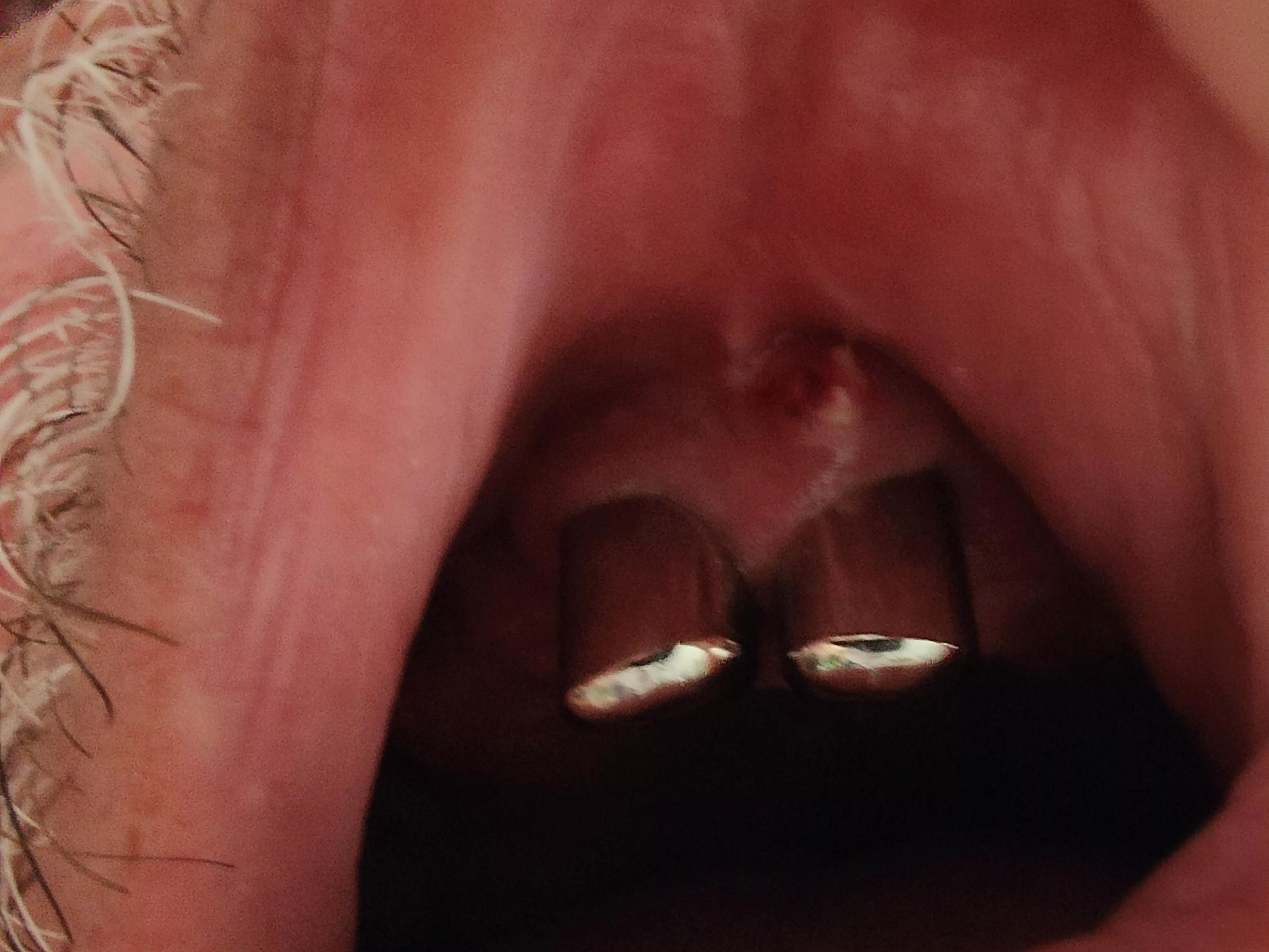 My father's last two upper teeth. He felt a sudden sharp pain under his prosthetic, and that's what we found underneath. posted by Cya-N1de