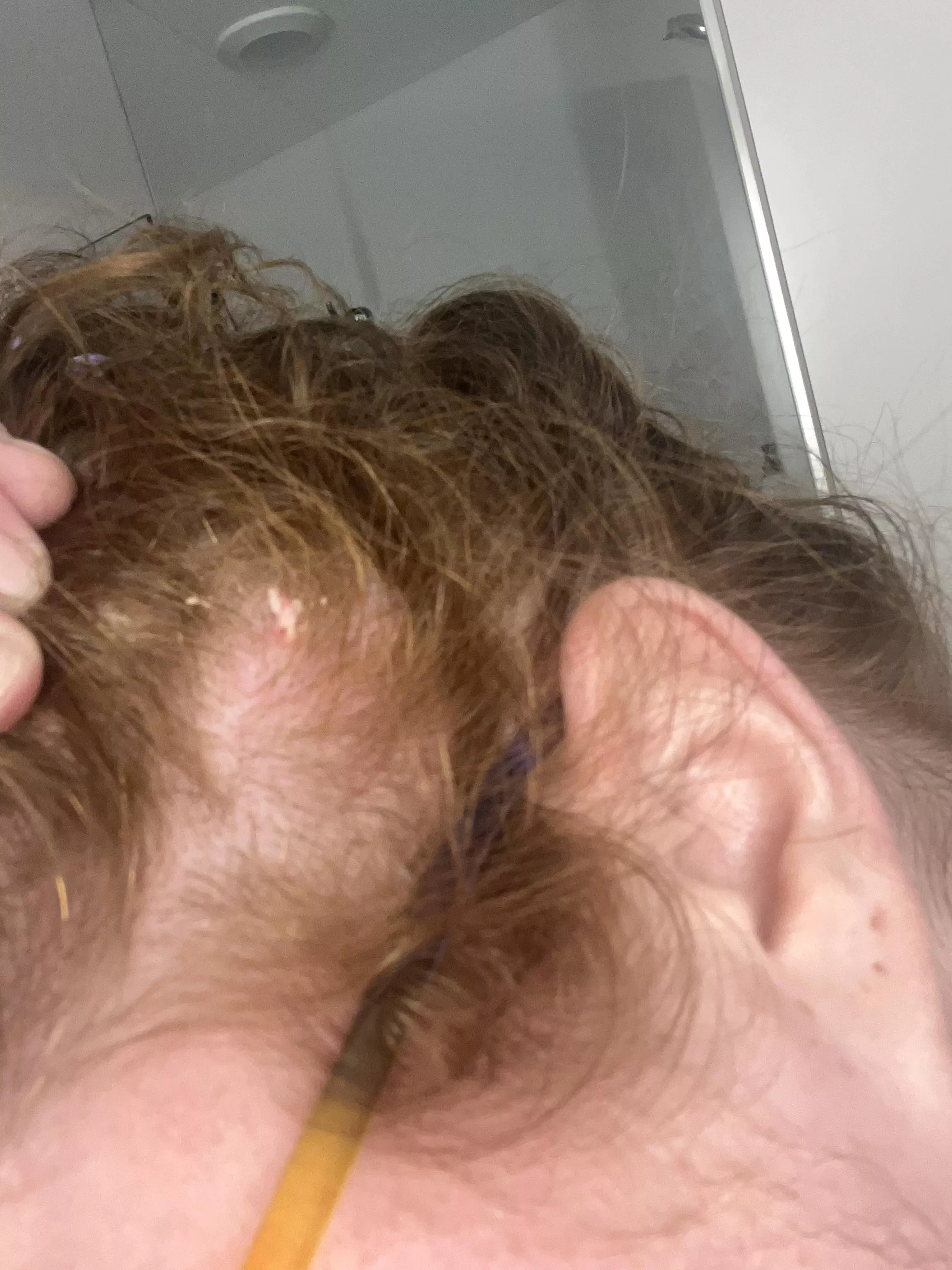 This was the best picture I could get, but the cyst on my scalp popped when I put my hair up for bed ☠️ posted by irlmerida