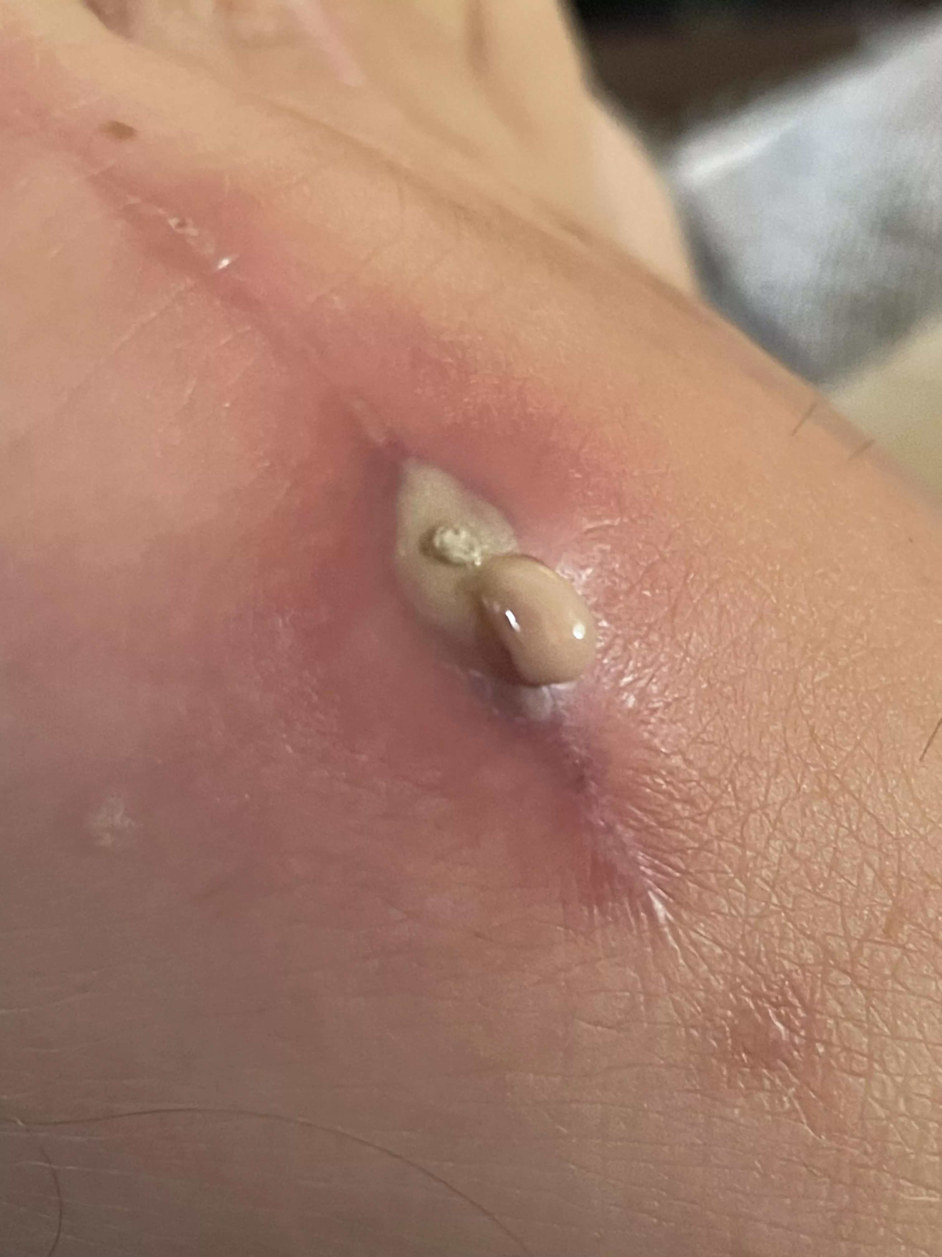 Wife’s bone growth removal site. posted by Cjd2x