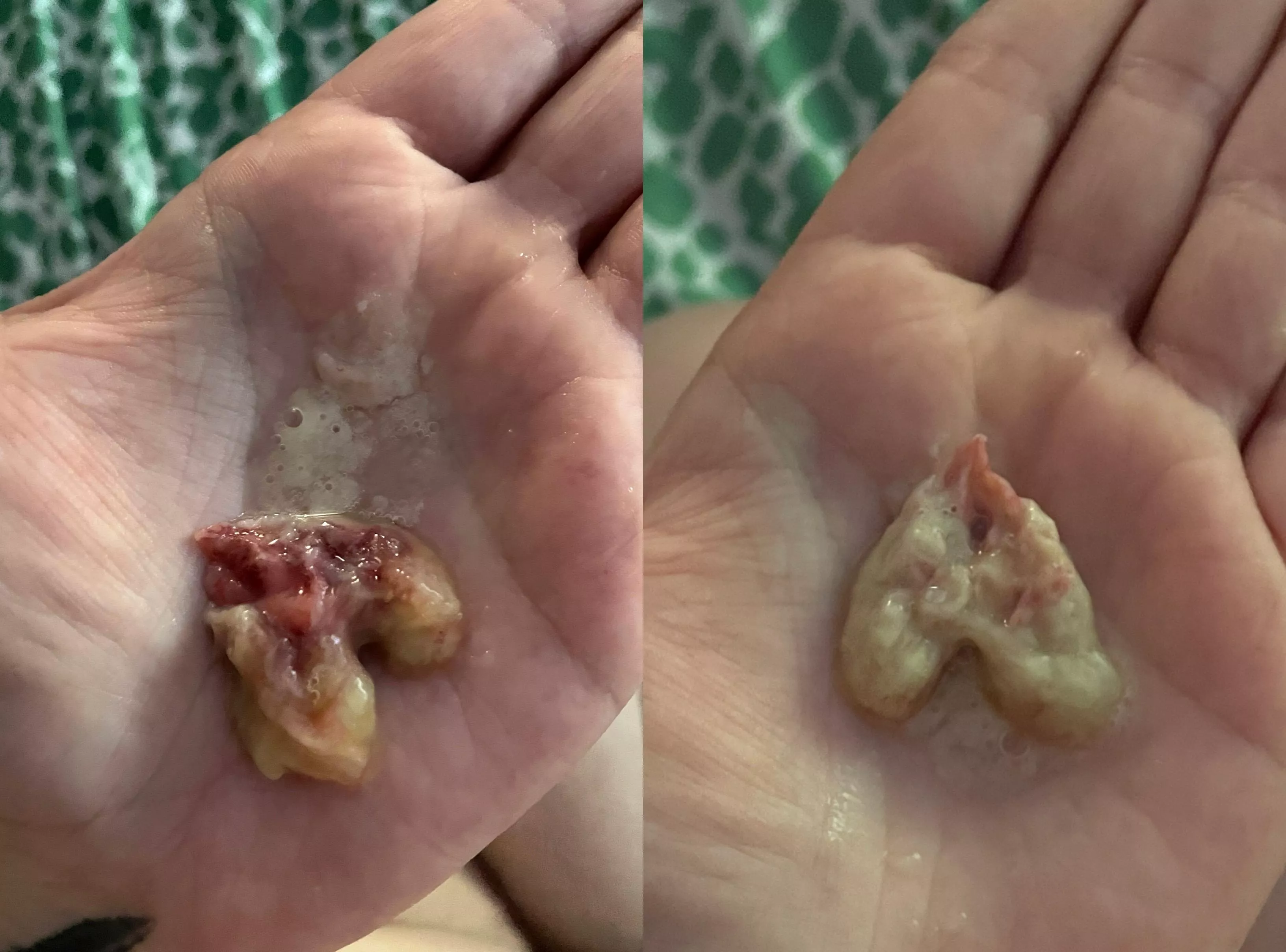 Birthed (coughed) out this mucus ball after being sick for 5 weeks and now I can BREATHE! posted by lilachub