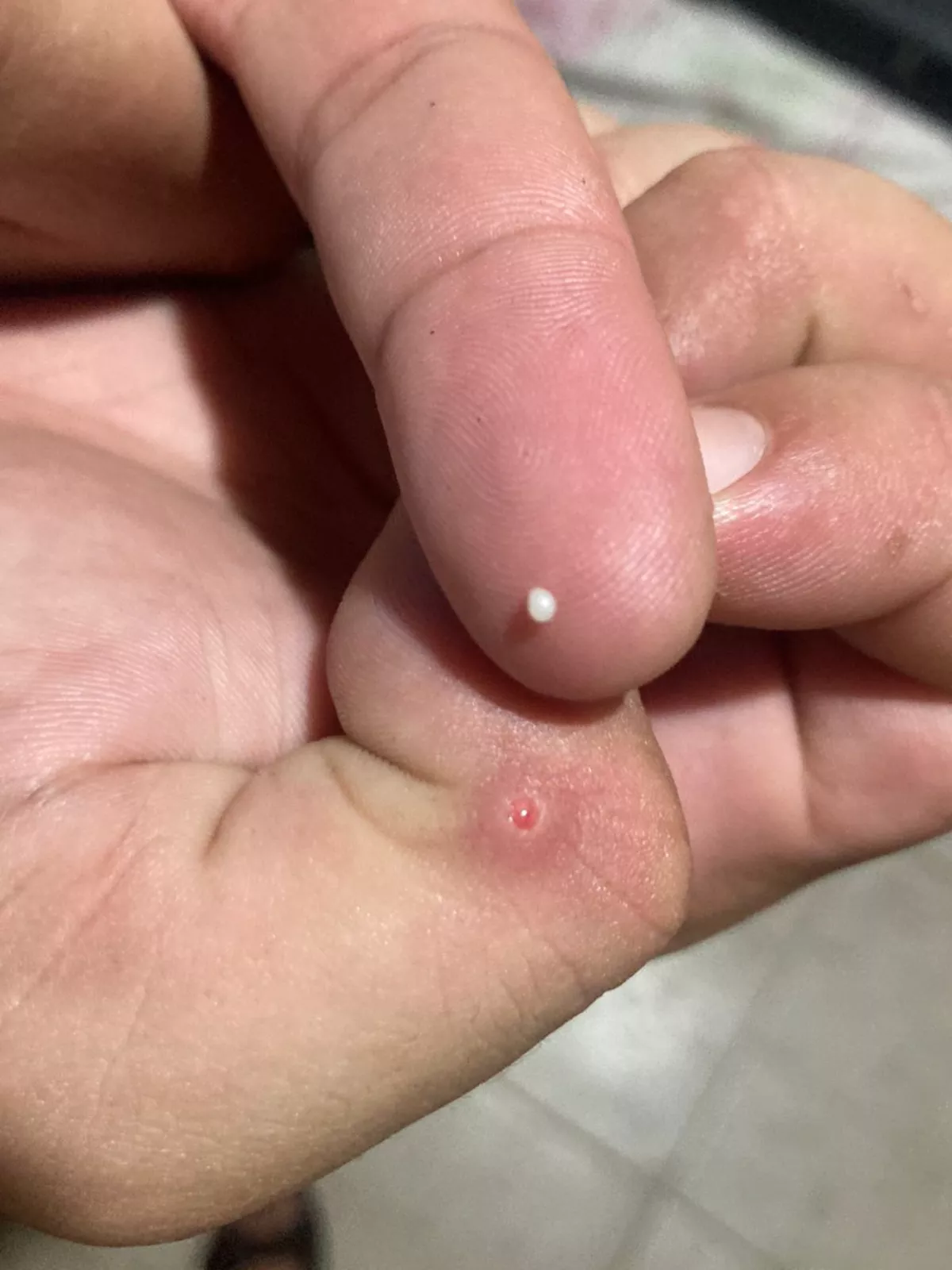 It grows once a year in the same spot under my skin and i have to cut and remove. What is this thing? posted by ISaucepleaseI