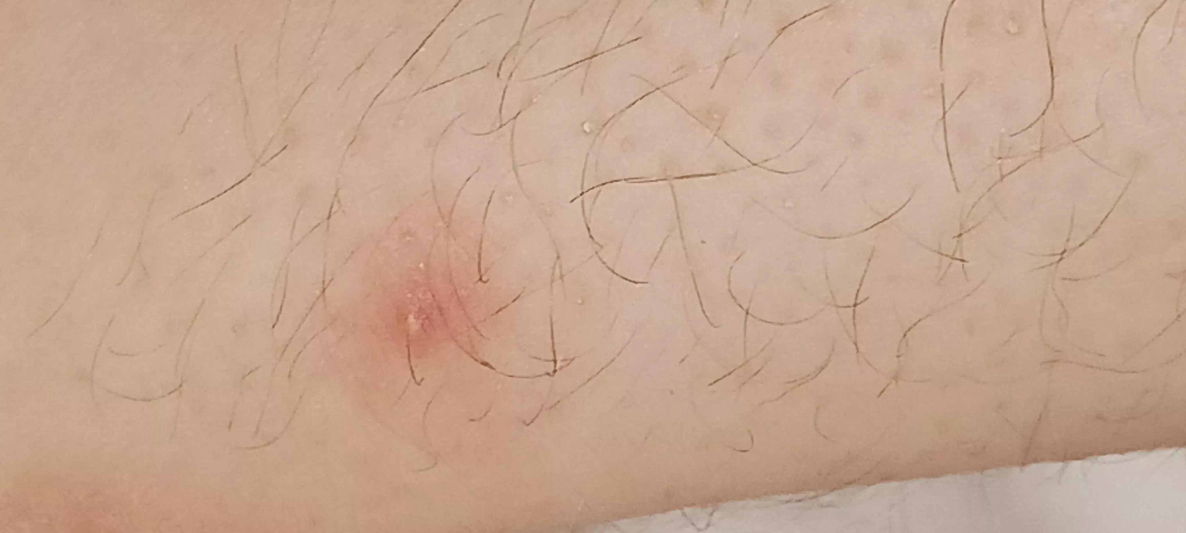 Found this very painful and annoying bump on my ankle, wondering if i should pop it. posted by Gabi_Likes_Blood
