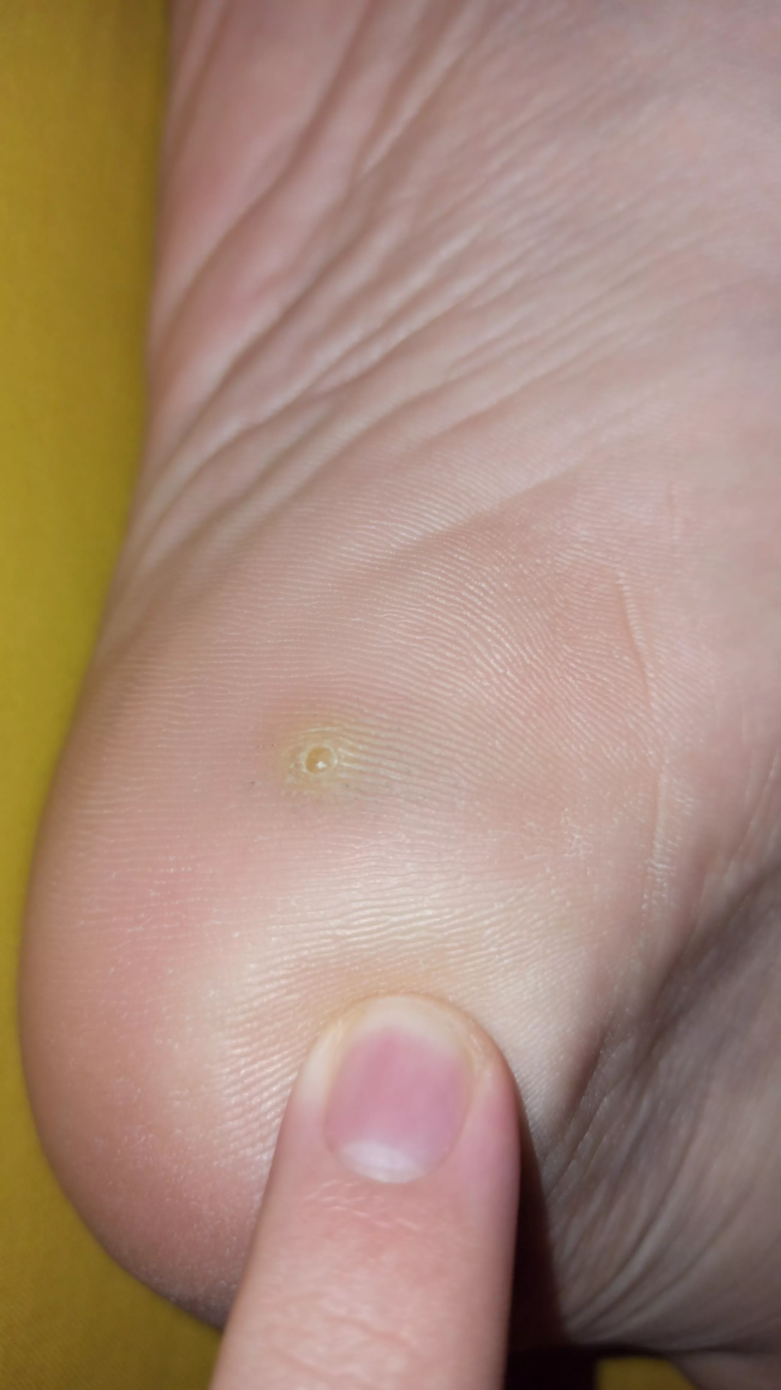 This fucker's been bothering me for the better part of two months, I've tried some removal bandaids but i think I'll just rip it out posted by Derpy_man5