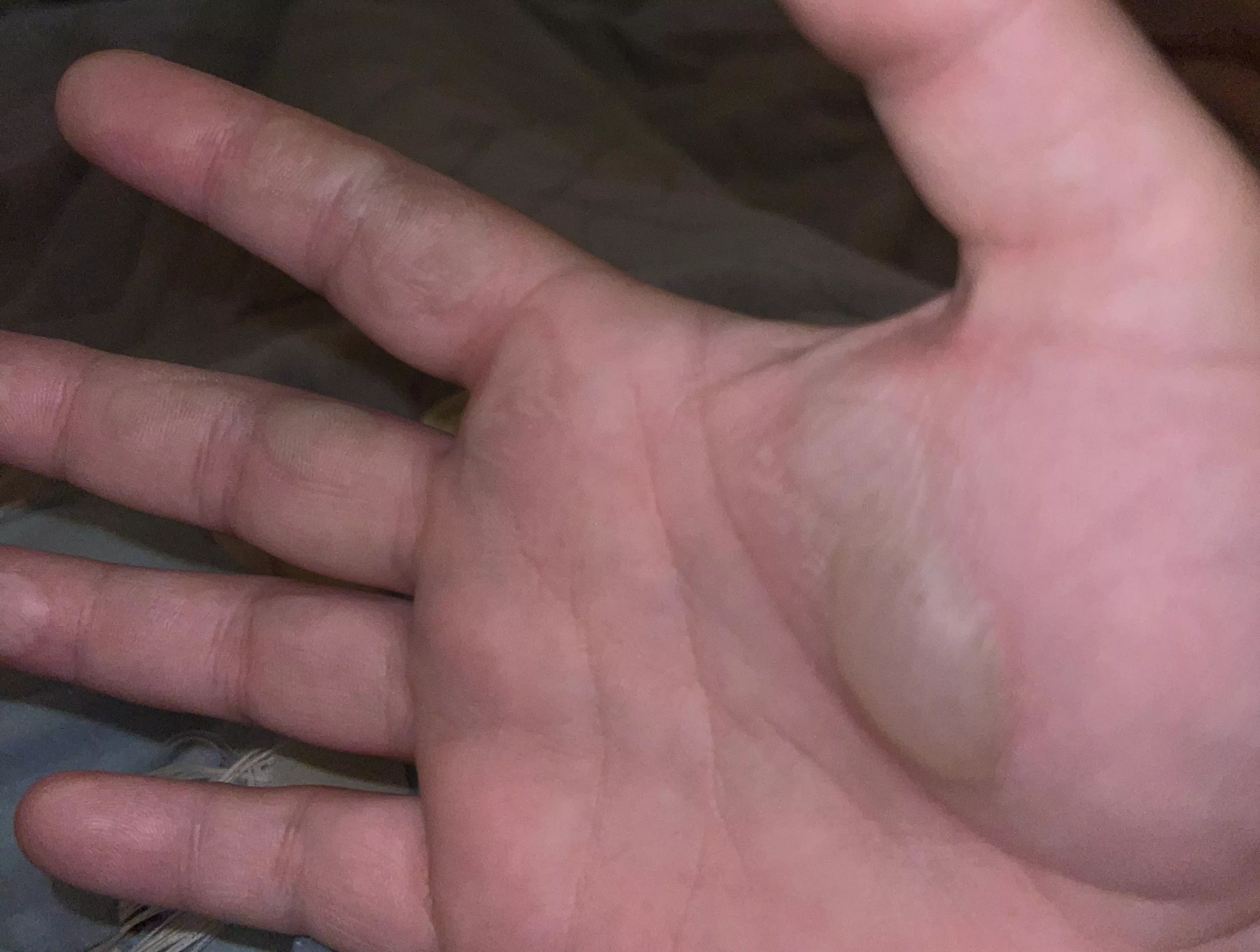 I burnt myself on a pan fresh out of the oven posted by Blufishie92