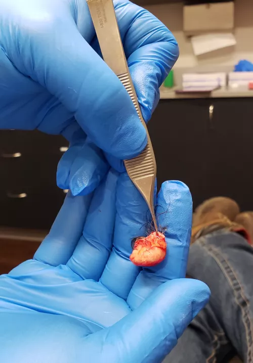 Had my 1.5 cm pilar cyst removed after 3± years by letsseeaction