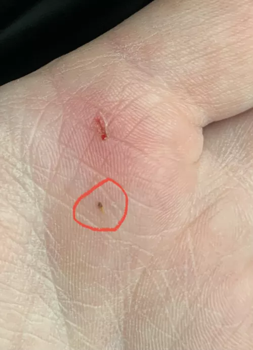 Tiniest splinter I’ve ever had! TLDR in comments :) by krackerjackstack