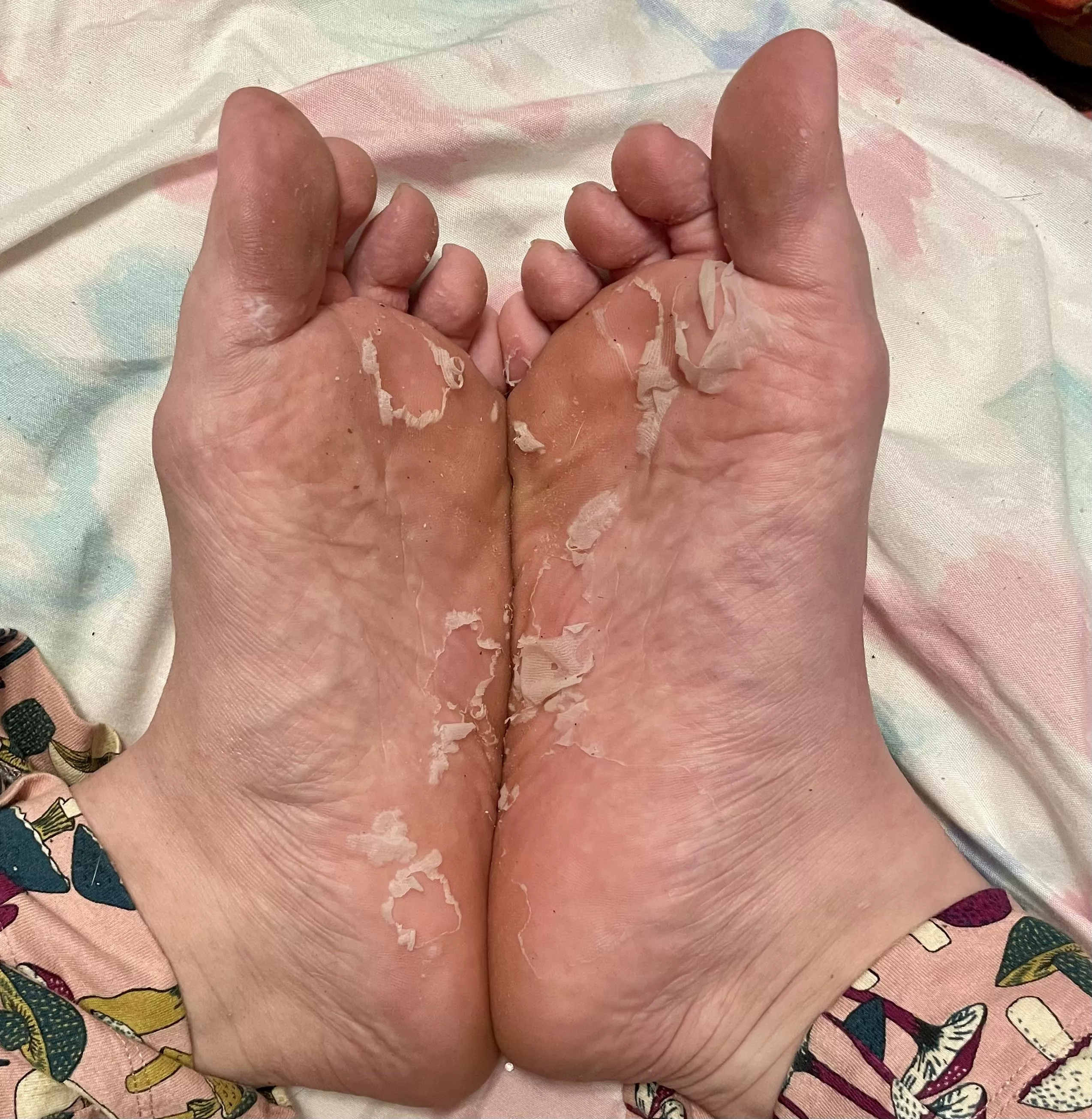 I used a foot peel mask posted by SoonKyuLove