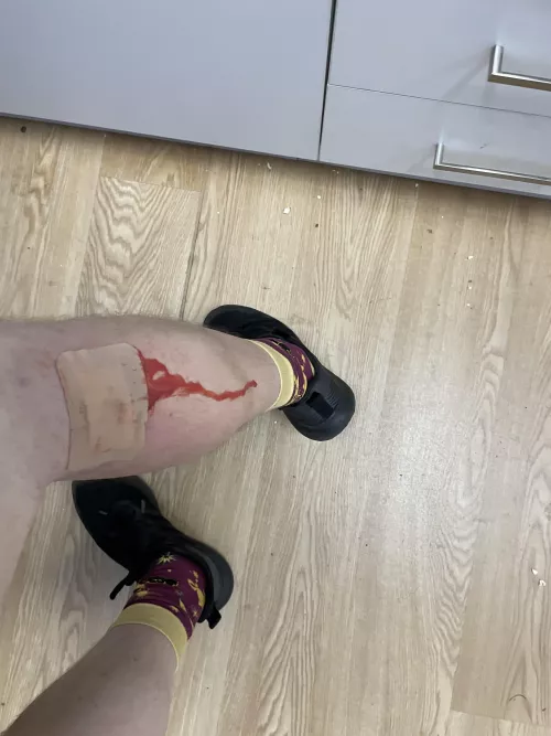 Finally a pus explosion by boristhemexican