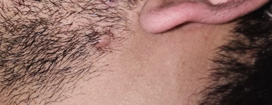 Boil scar?Had a boil almost 8 month back under the ear on the chin area and I have this raised bump now that won't go away. Anyone had this any solutions?? posted by Expensive-Cap-5792