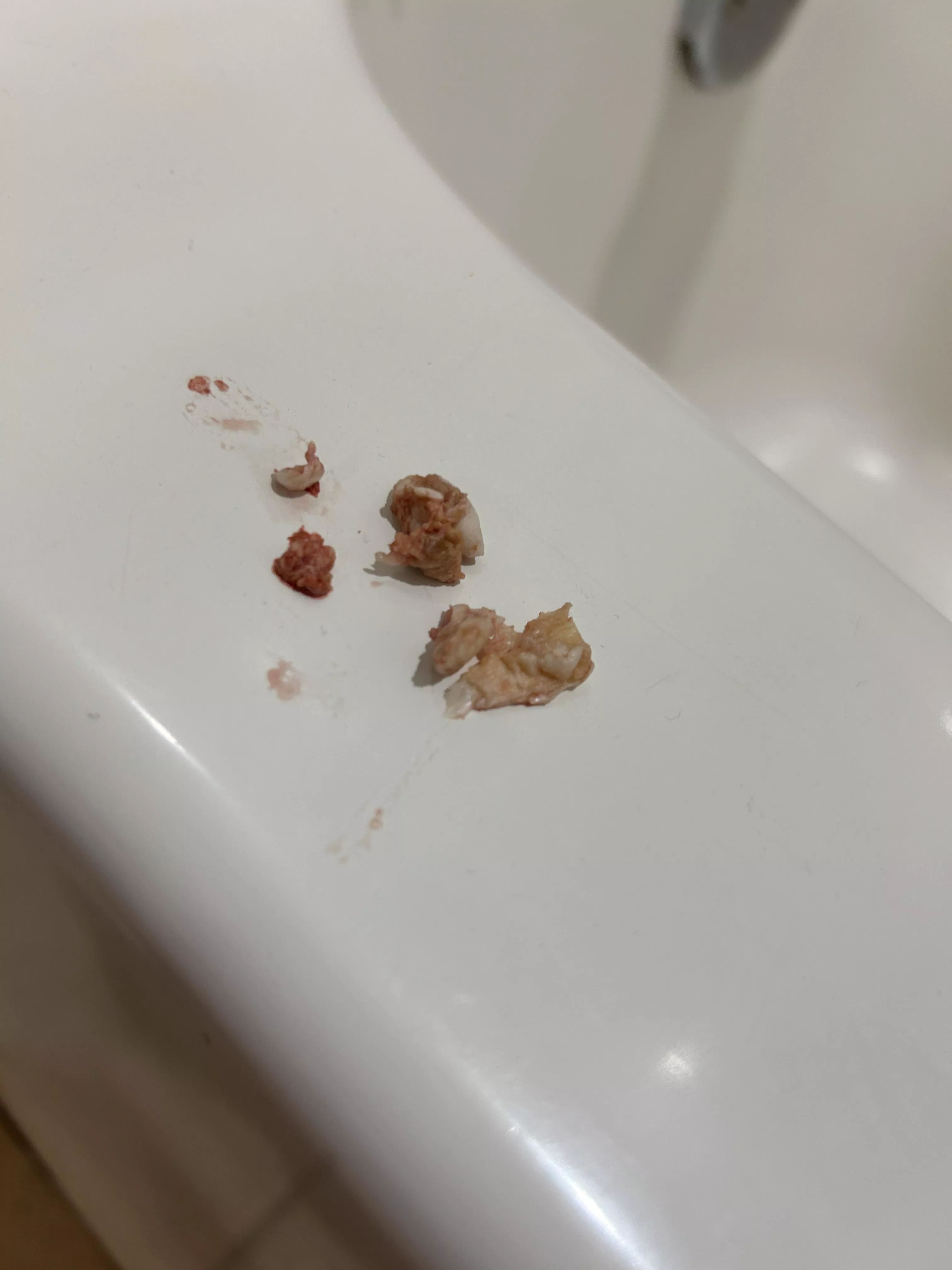 Bartholin Cyst Contents posted by beeznthetrap