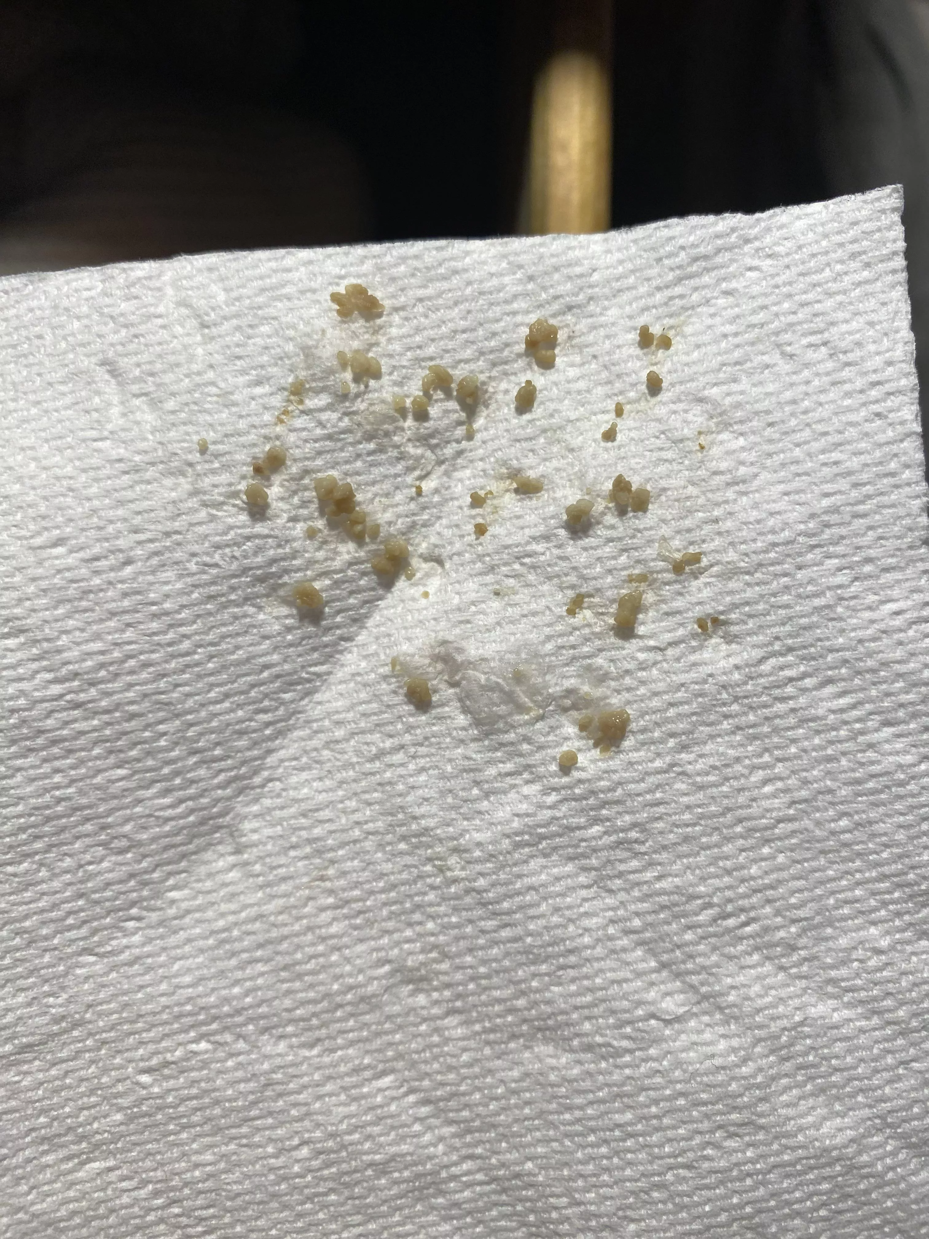 Tonsil stone record? posted by Czerkasij