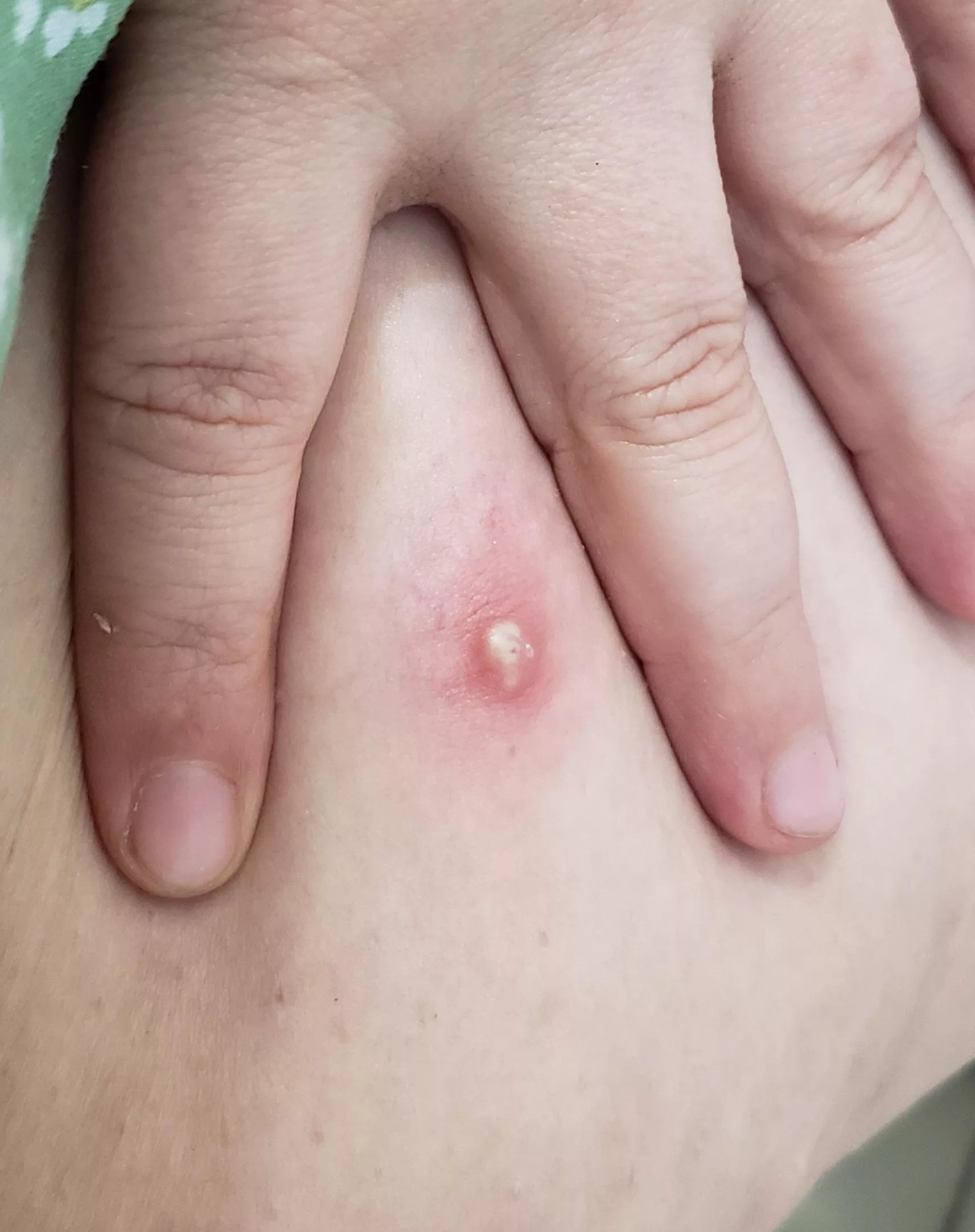 The doctor says to leave it and not to pop it... posted by BaconSyrop