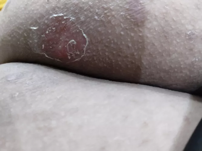 Cellulitis on my buttocks after 4 days of antibiotics by CodexHax