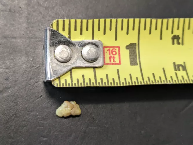 Just coughed up this monster by I_read_every_post