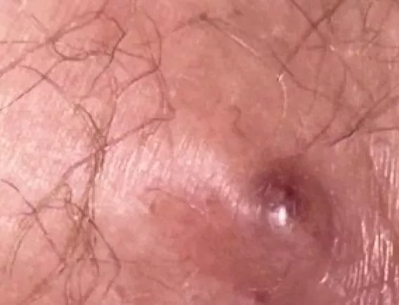 Hemorrhoid or pimple or ingrown oh my! posted by Strwb3rrym3rmaid