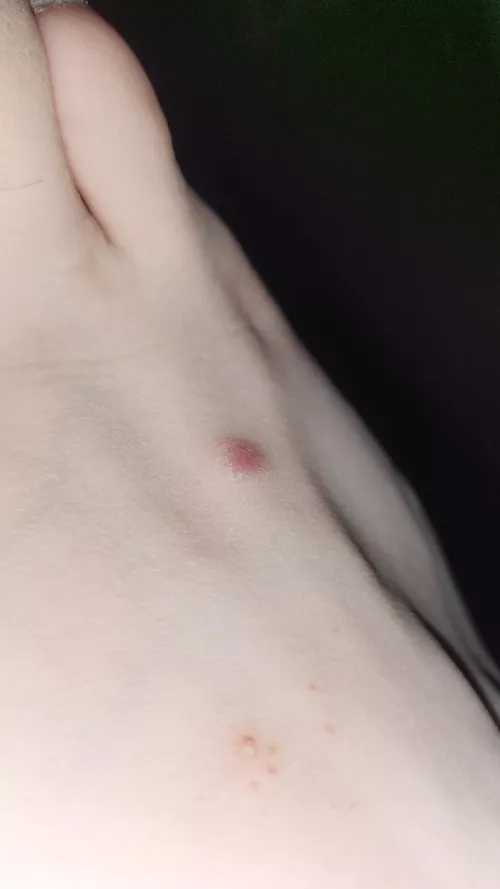 Weird red bump on my foot. What is this!??!?! by Cheap-Difficulty-163