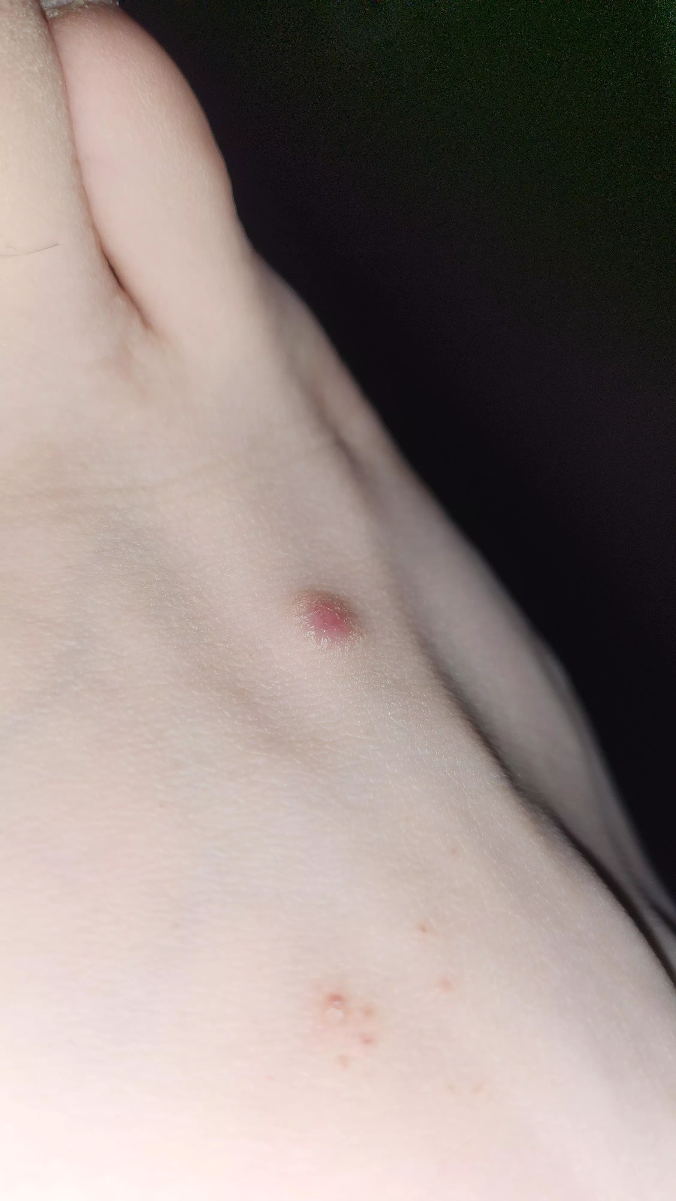 Weird red bump on my foot. What is this!??!?! posted by Cheap-Difficulty-163