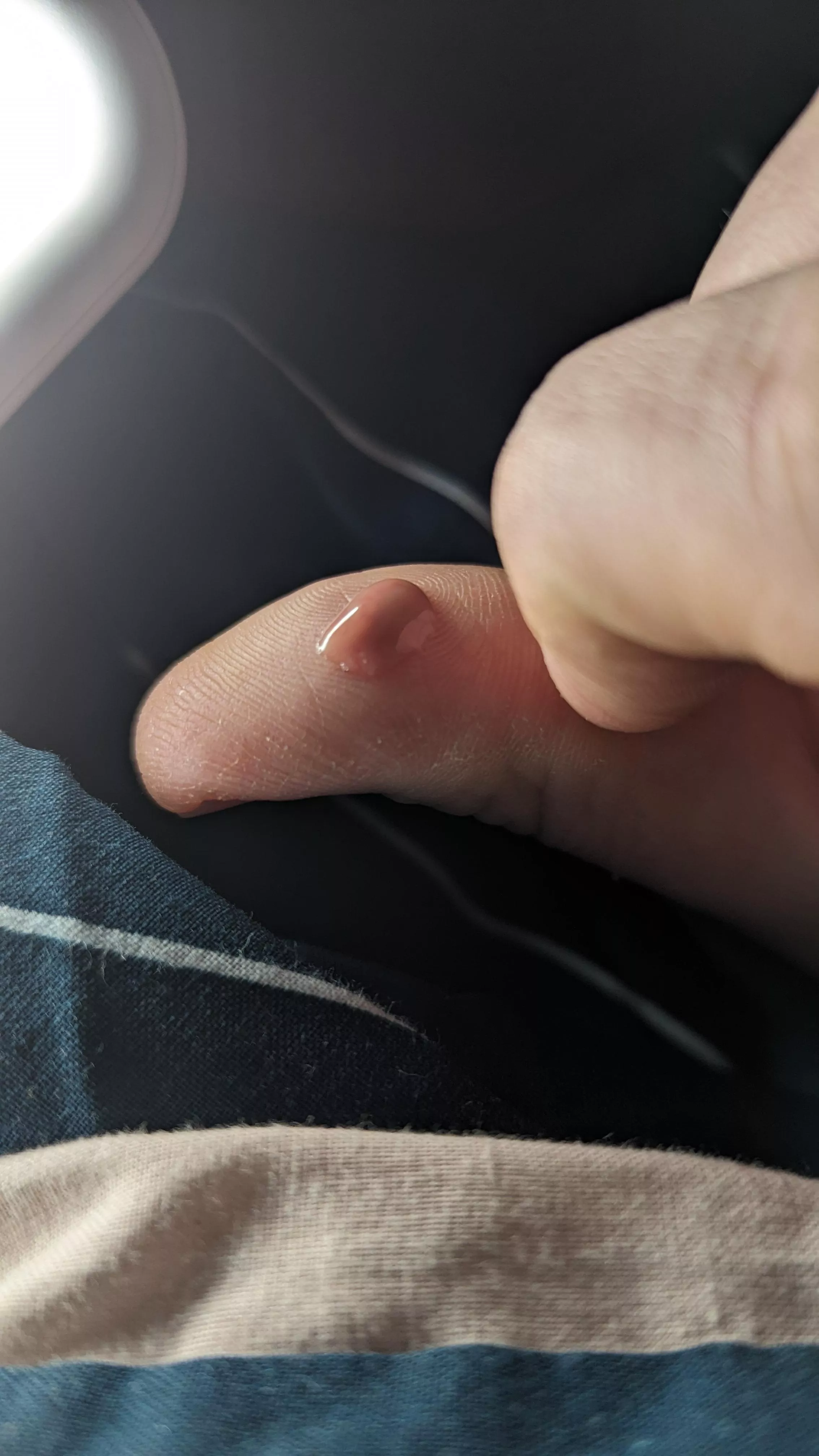 My armpit felt so much better after this mess came out. posted by SerLurkzAlot