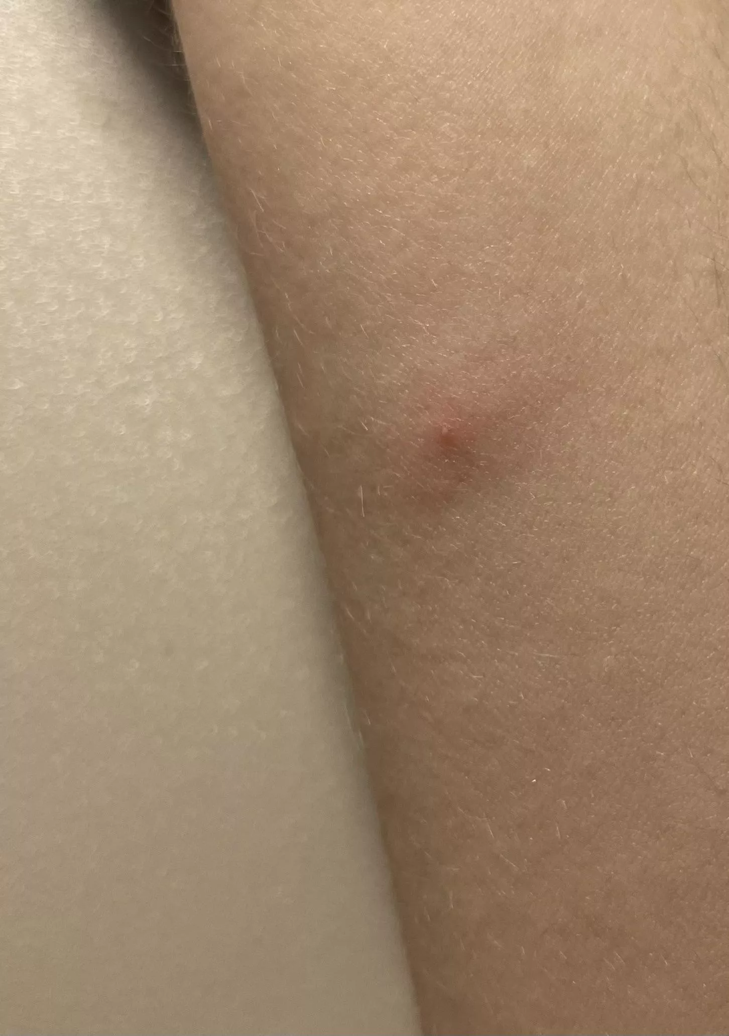 woke up with this, what could this be? posted by Freckled_Boye