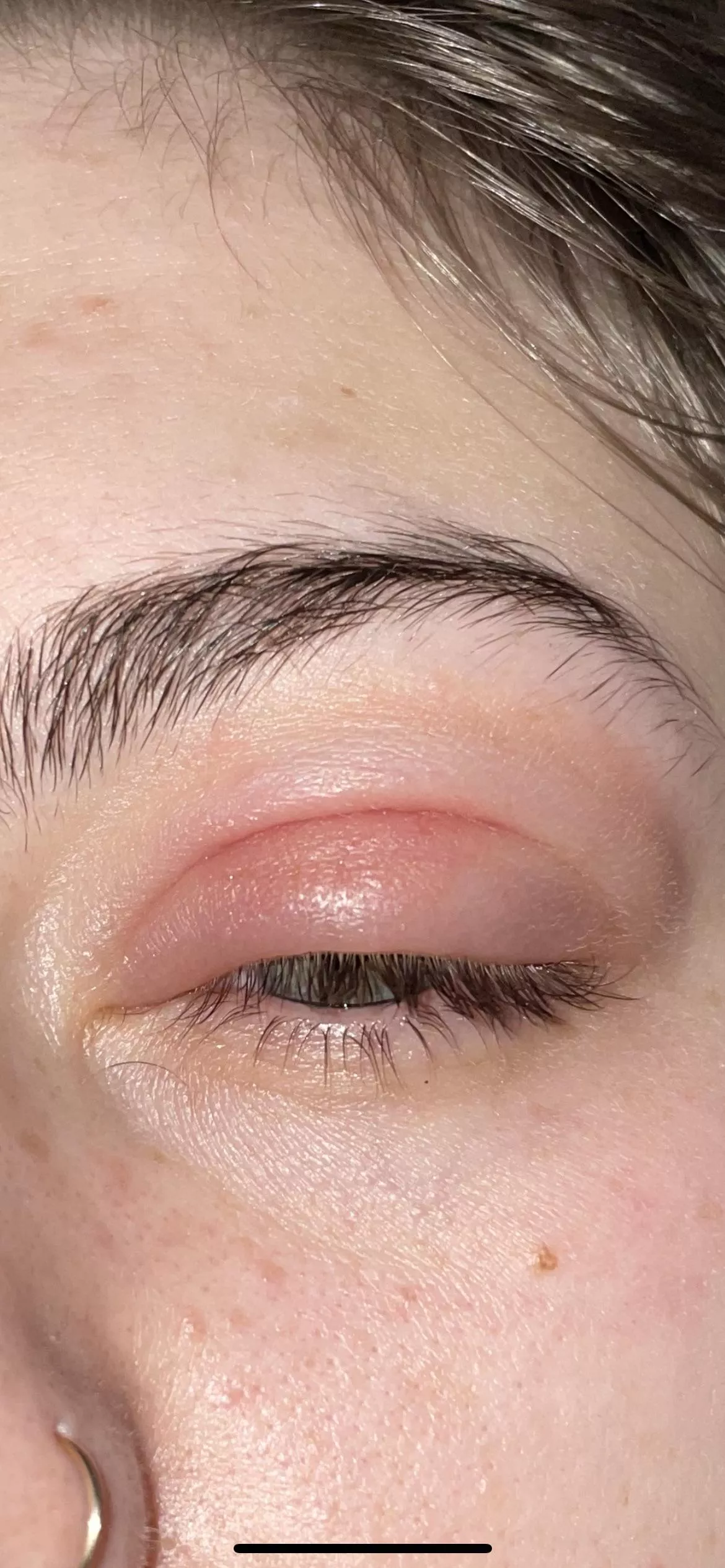 Forbidden pop! 2nd Presepstic cellulitis posted by chuggychoochoo