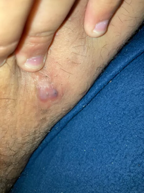 Located in my inner thigh, this thing looks pretty gnarly. (Marked as NSFW for its location.) by HeftyFuel161