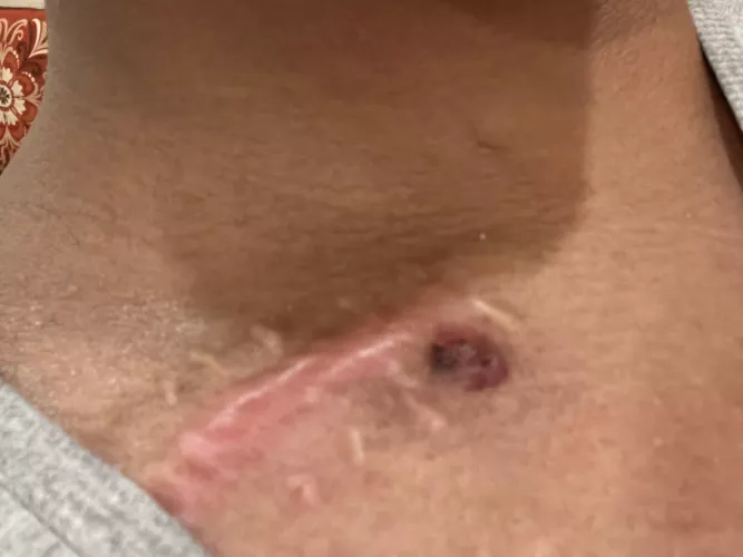 Pimple around surgical scar 5 months later by smexysinXD