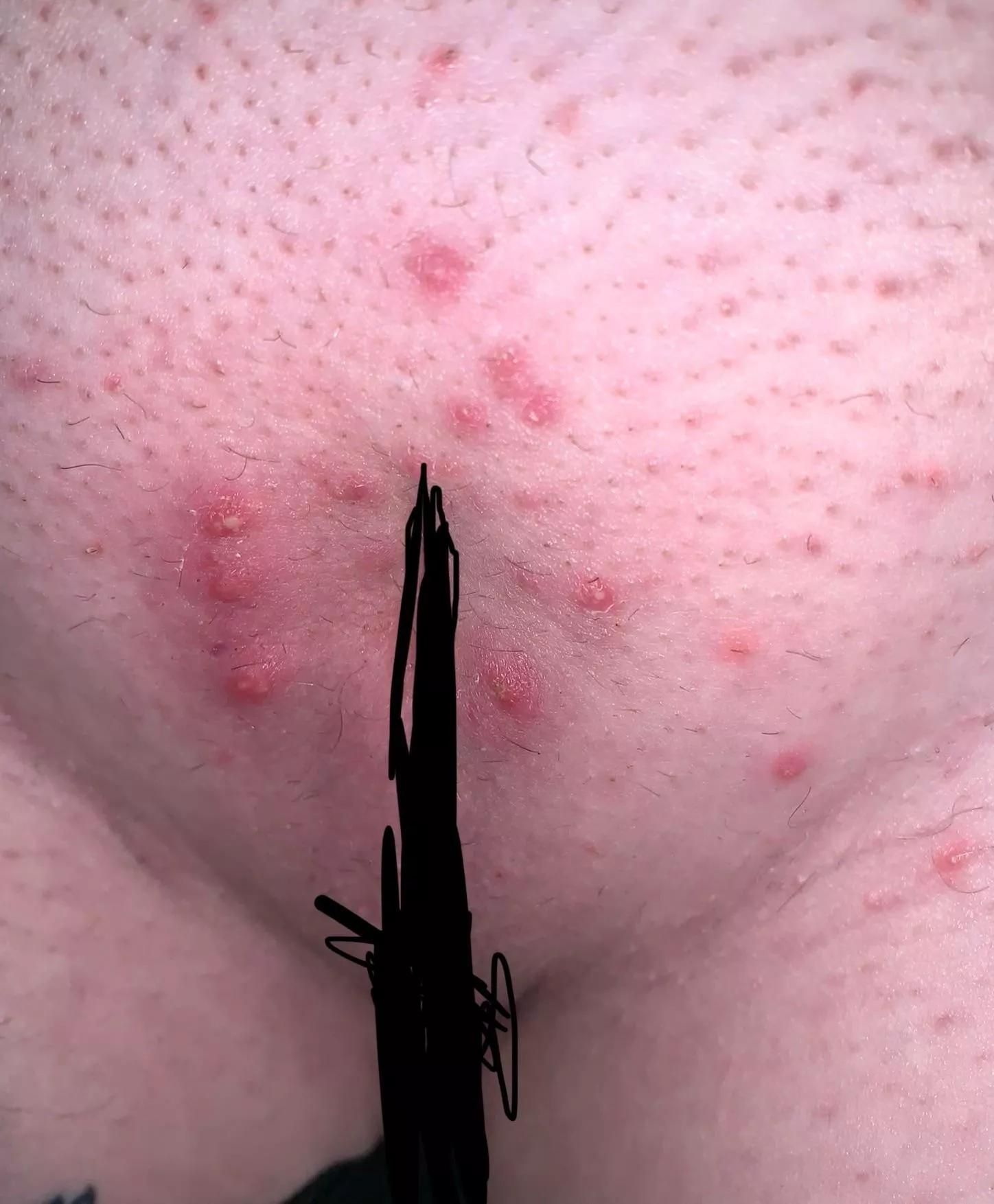 Got a Brazilian 8 days ago and this is what I’m left with posted by poppitypop123