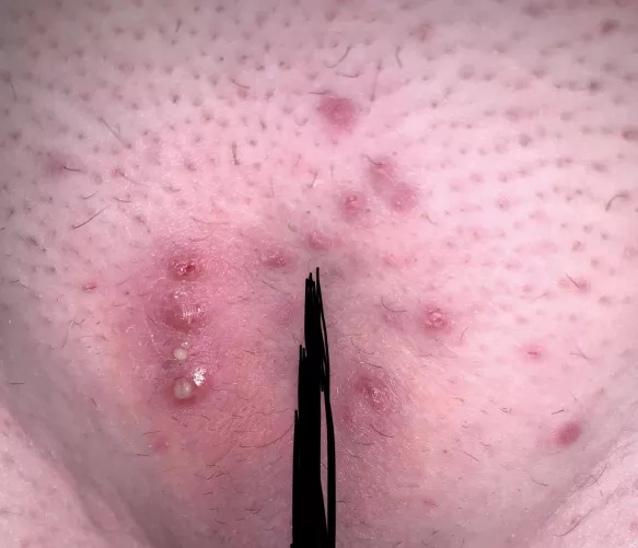 Part two of my first Brazilian after a long warm shower by poppitypop123