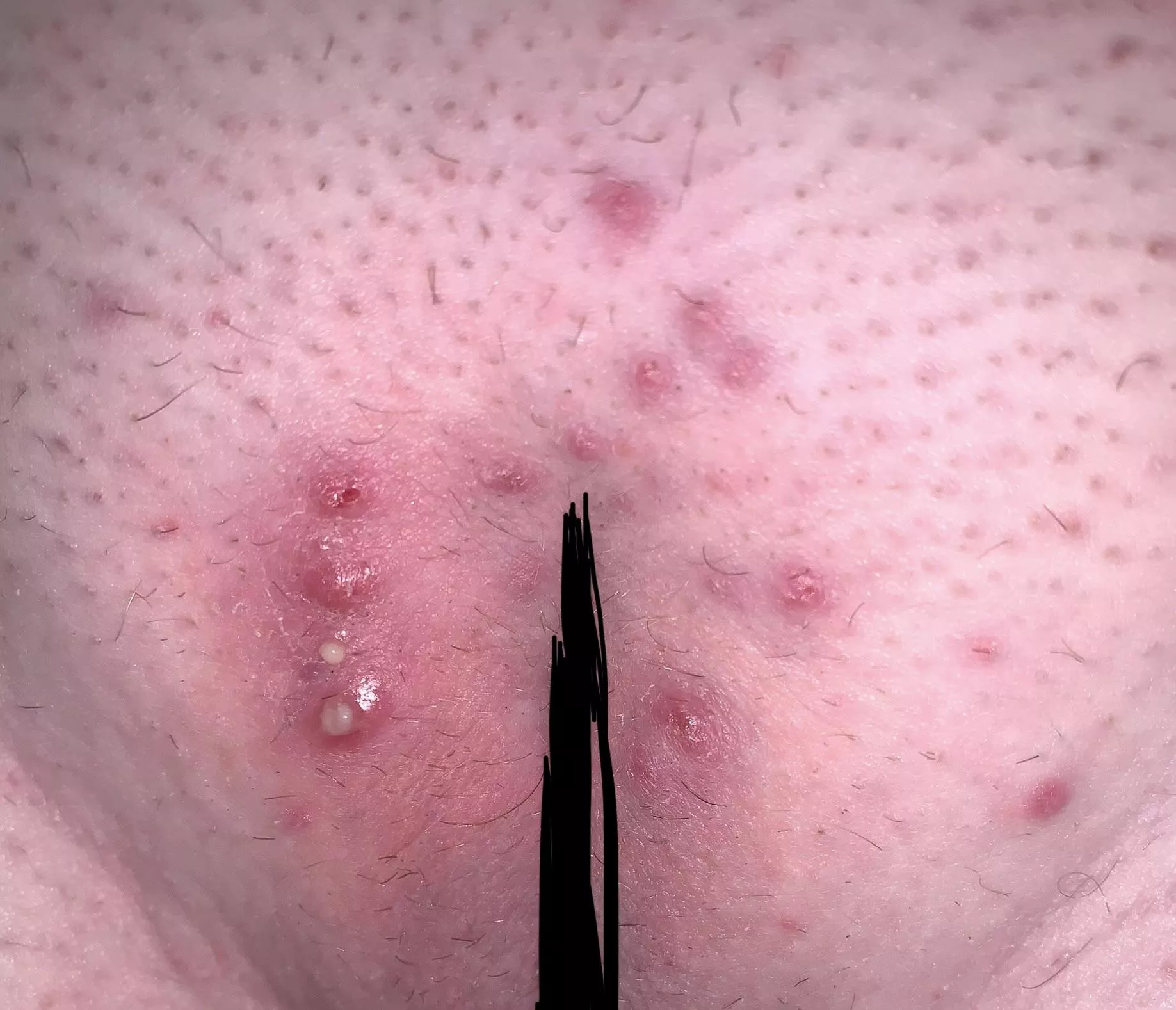 Part two of my first Brazilian after a long warm shower posted by poppitypop123